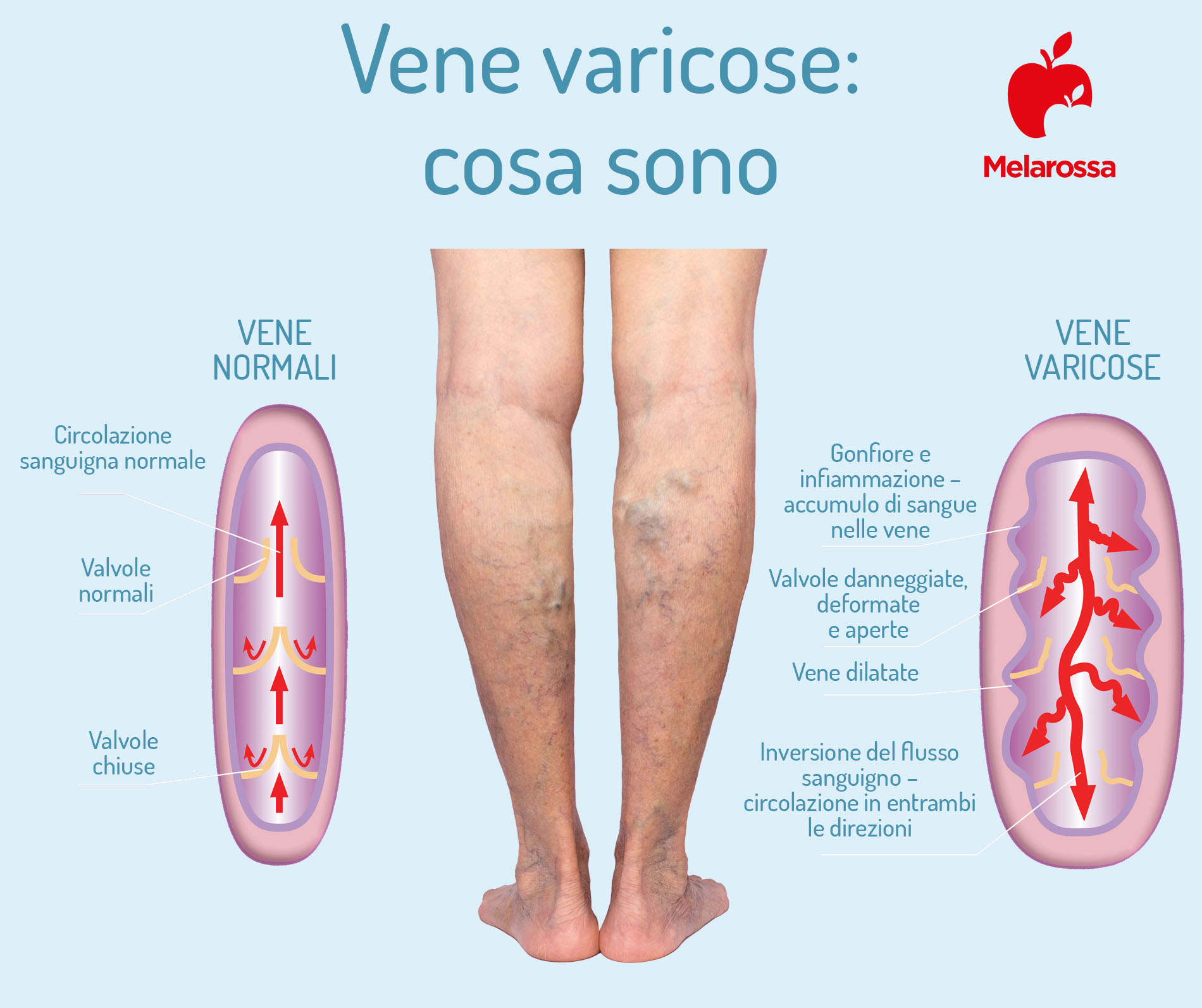 Vene varicose: cosa sono, sintomi, cause, cure e rimedi delle varici 1 vene varicose: cosa sono