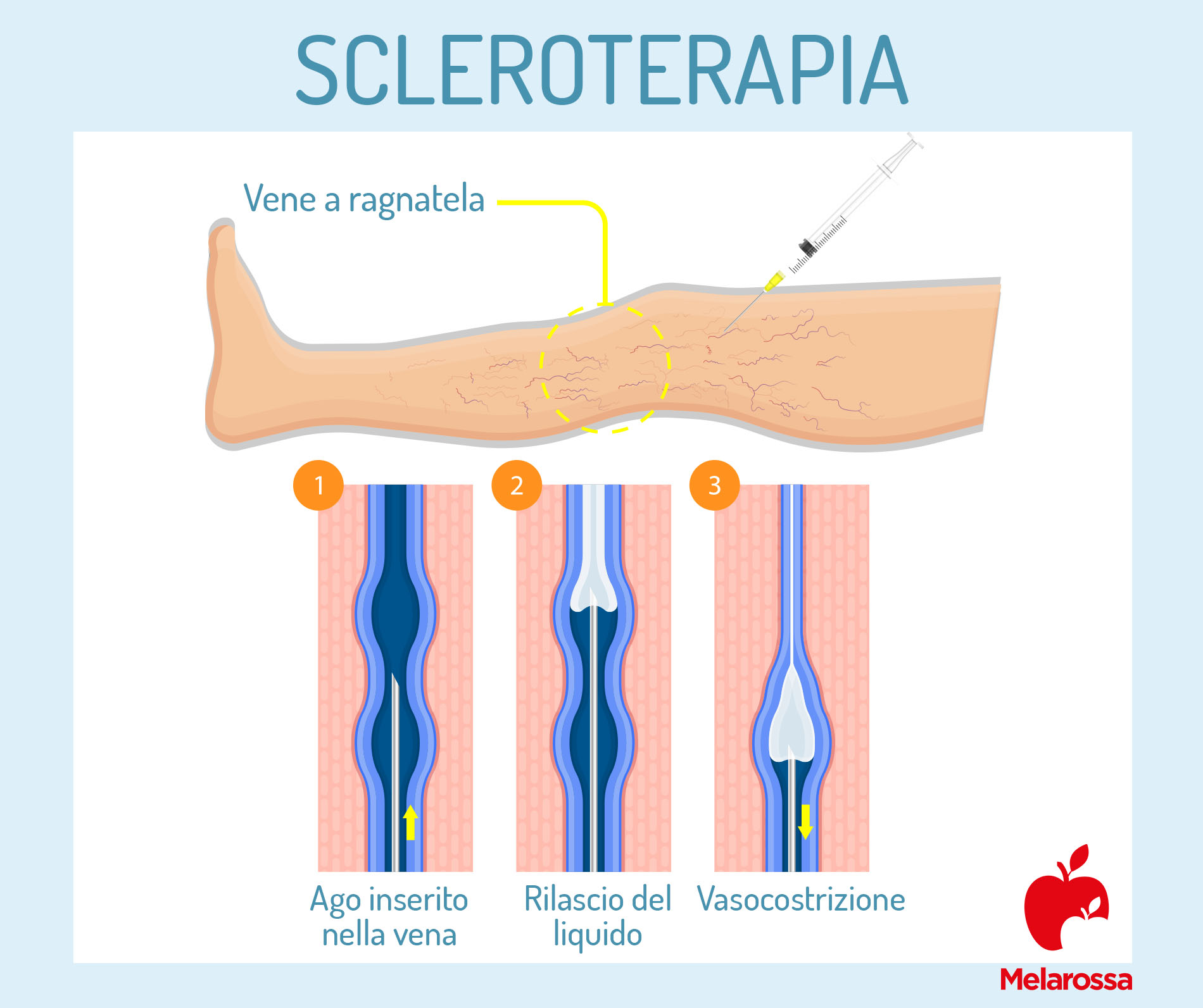 Vene varicose: cosa sono, sintomi, cause, cure e rimedi delle varici 6 vene varicose: scleroterapia