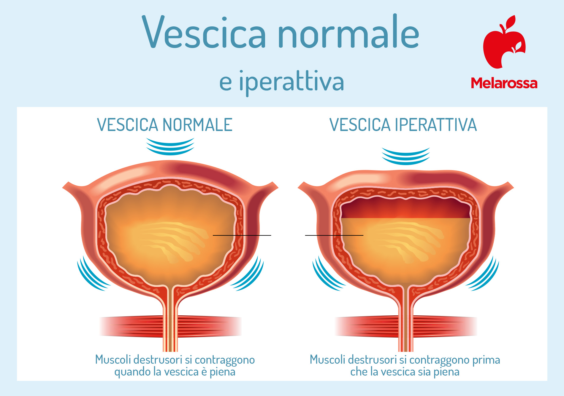 Incontinenza urinaria: maschile e femminile, sintomi, cause e rimedi 2 grafica sul funzionamento della vescica nell'incontinenza urinaria