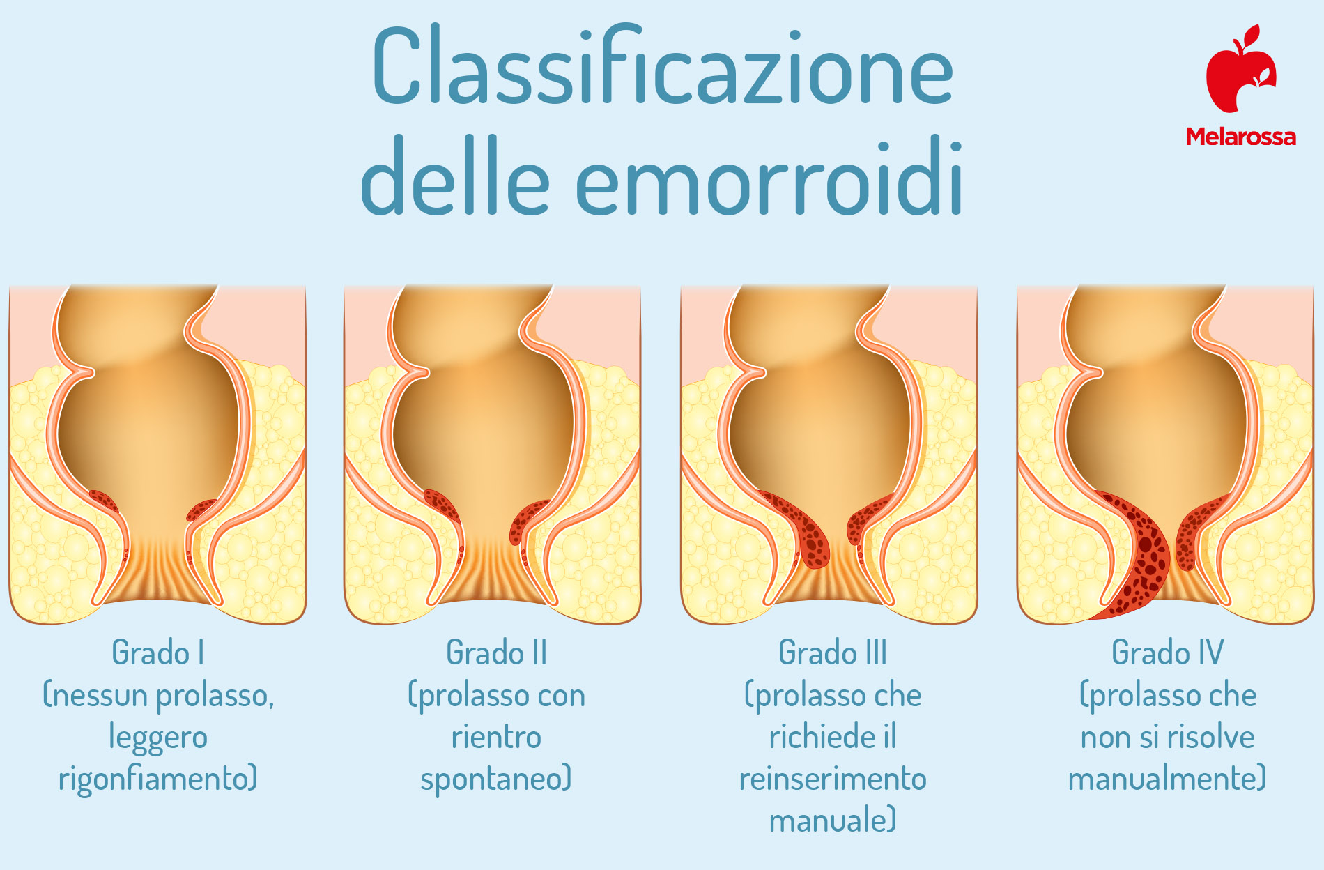 Emorroidi: cause e sintomi, cosa mangiare, cure e rimedi 2 emorroidi: classificazione
