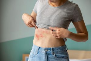 Herpes zoster o fuoco di Sant&rsquo;Antonio: cura, cause, sintomi e cibi da evitare