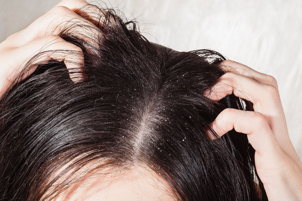 Shampoo antiforfora: la classifica dei migliori sul mercato 1 migliori shampoo antiforfora