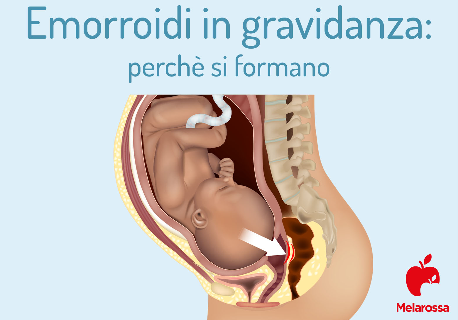 Emorroidi in gravidanza: cause, rimedi, come curarle e cosa fare 1 emorroidi in gravidanza: perché si formano