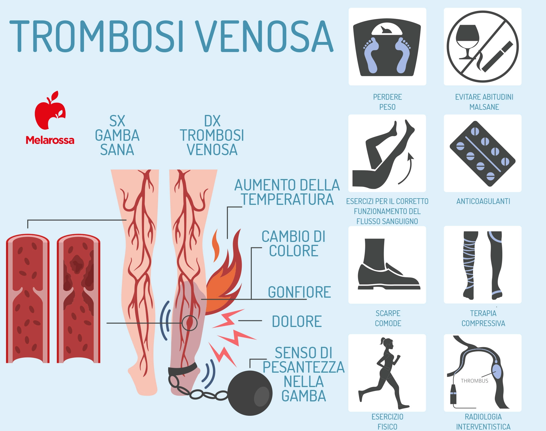 Trombosi: venosa o superficiale, sintomi, cause e come si cura 2 Una grafica sulla trombosi venosa