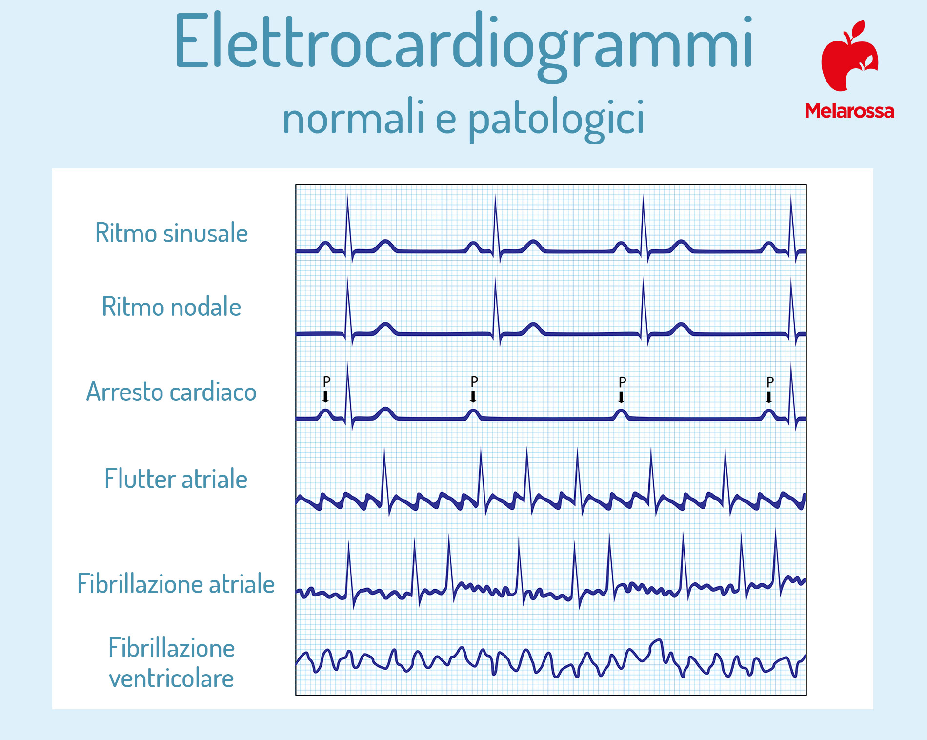 Elettrocardiogramma (ECG): cos'è, quando farlo e cosa si vede 2 elettrocardiogramma: risultati normali e patologici