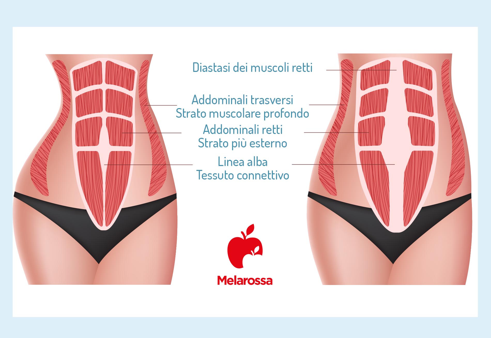 Addominoplastica: come funziona, benefici e risultati, costi 1 addominoplastica diastasi addominale