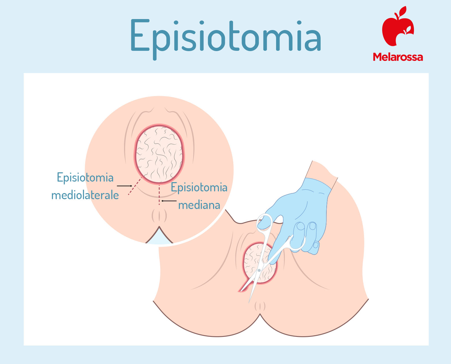 Episiotomia: che cos'è, quando è necessario il taglio vaginale, come si esegue e a cosa serve, cicatrice, guarigione e conseguenze 1 episiotomia: che cos'è