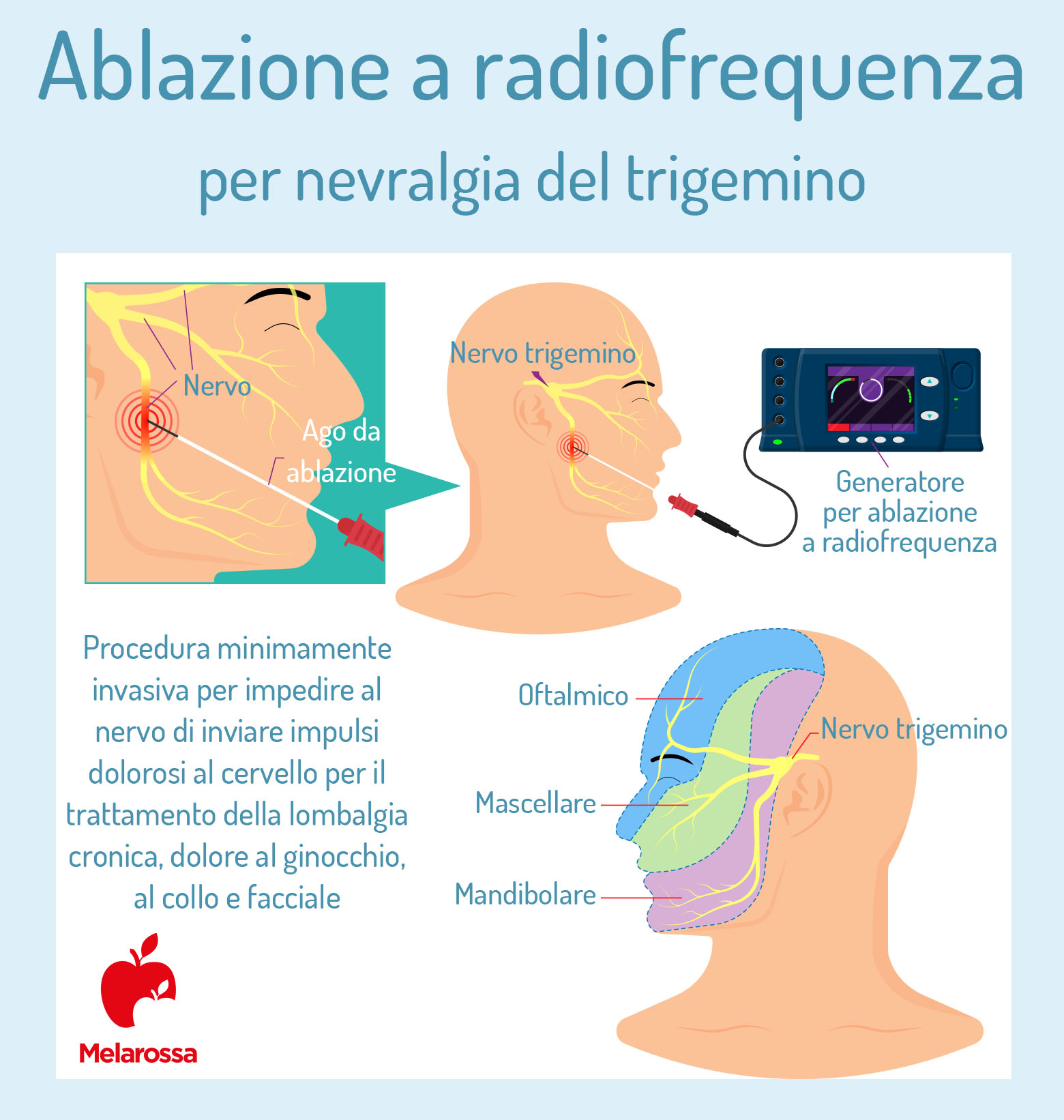 Nevralgia del trigemino: che cos'è, sintomi e cause, diagnosi e cura 4 nevralgia del trigemino: cure