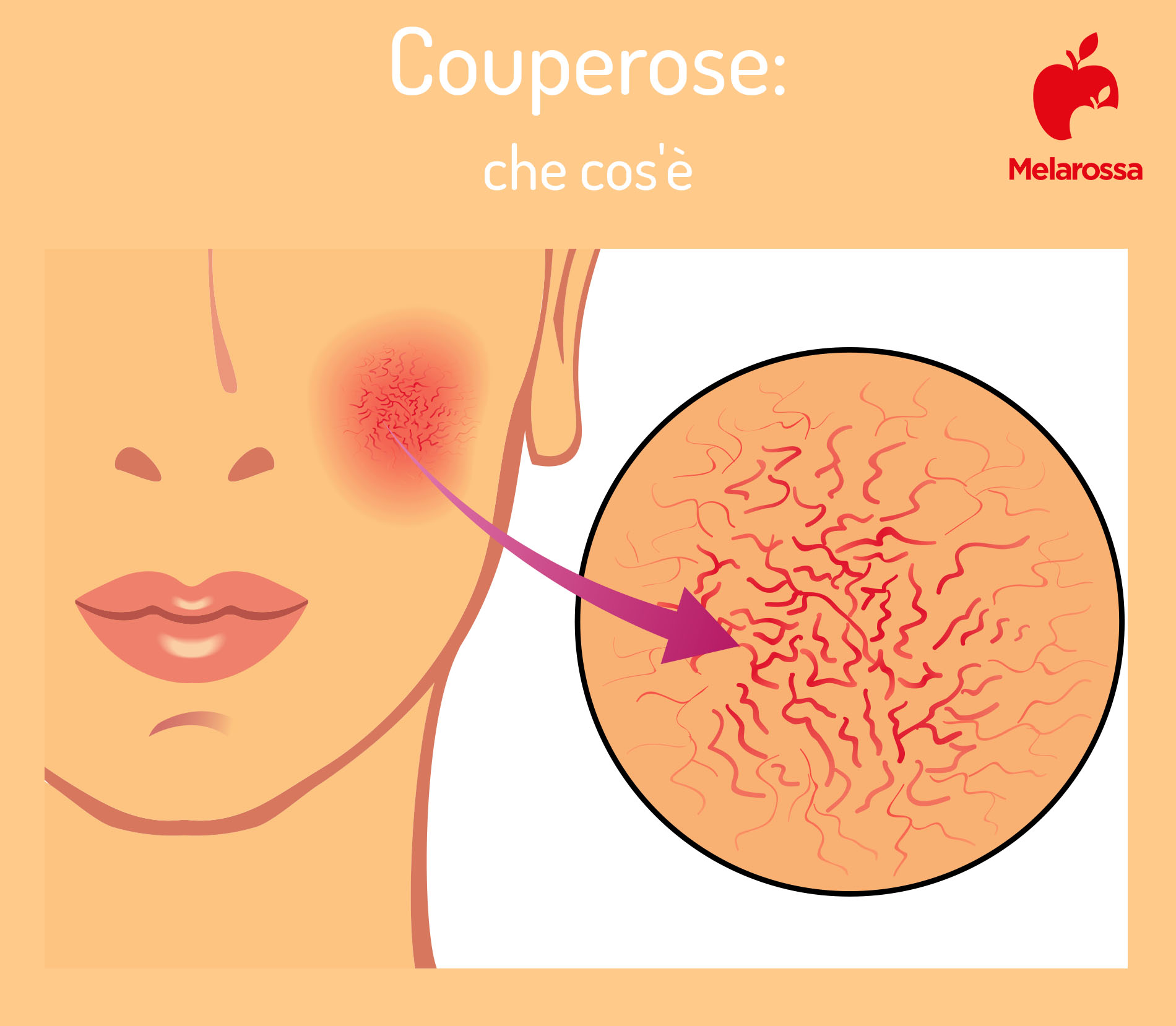 Couperose: che cos'è, cause e sintomi, creme e trattamenti per curarla, come prevenire 1 couperose: che cos'è