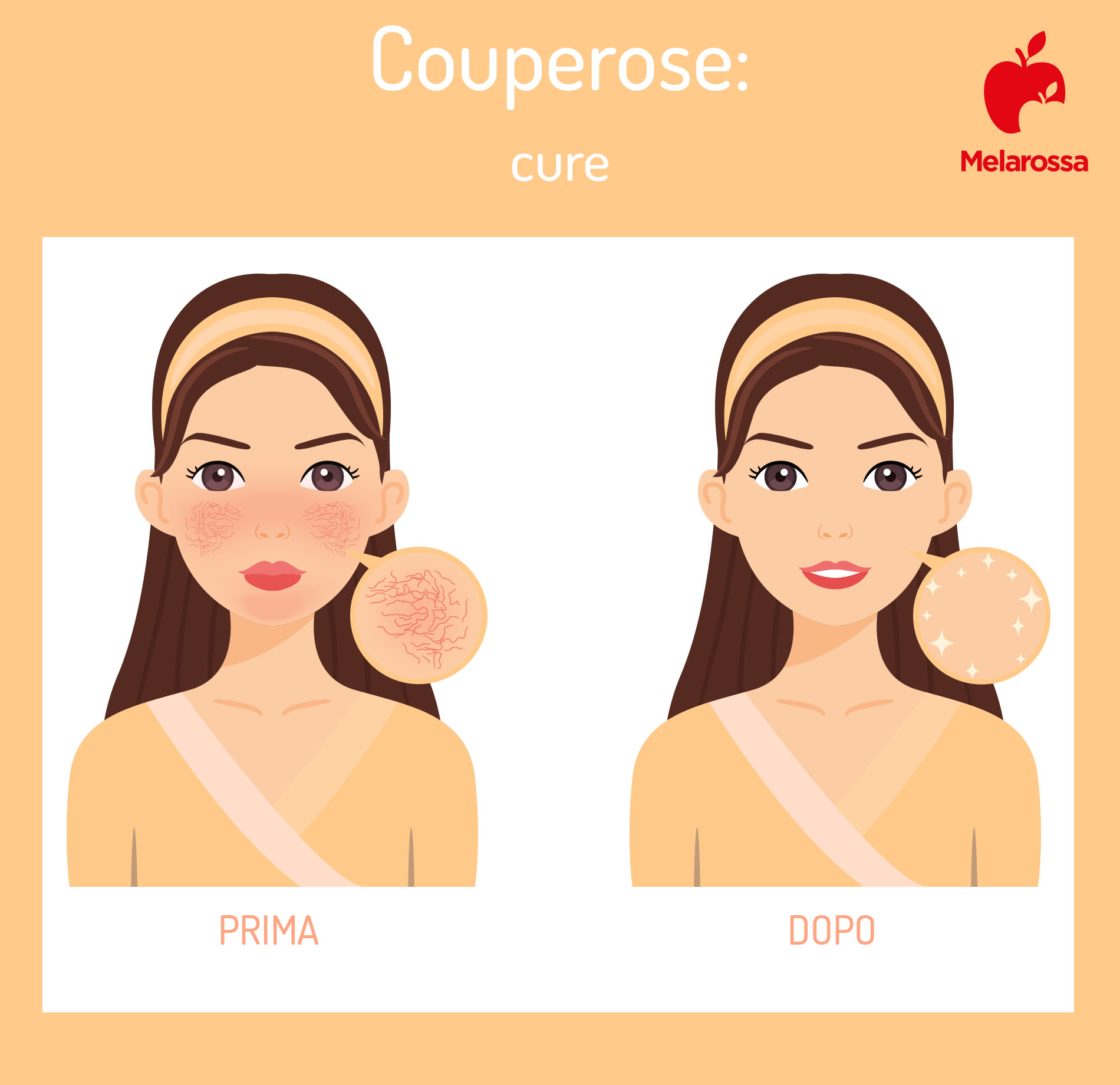 Couperose: che cos'è, cause e sintomi, creme e trattamenti per curarla, come prevenire 4 come curare la couperose