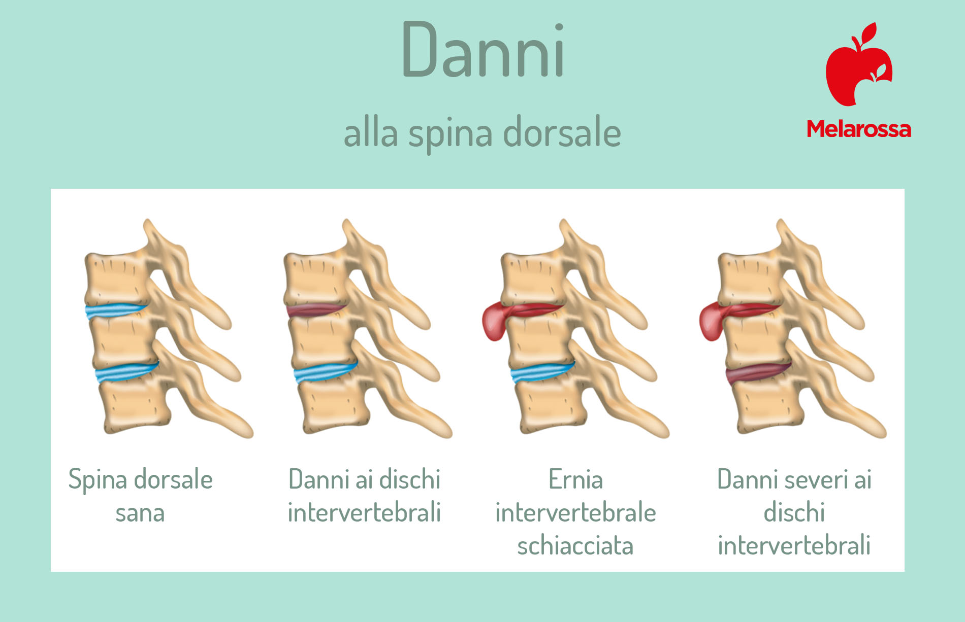 Lombalgia: che cos'è, cause, sintomi, possibili terapie e esercizi per prevenire 5 lombalgia: danni alla spina dorsale