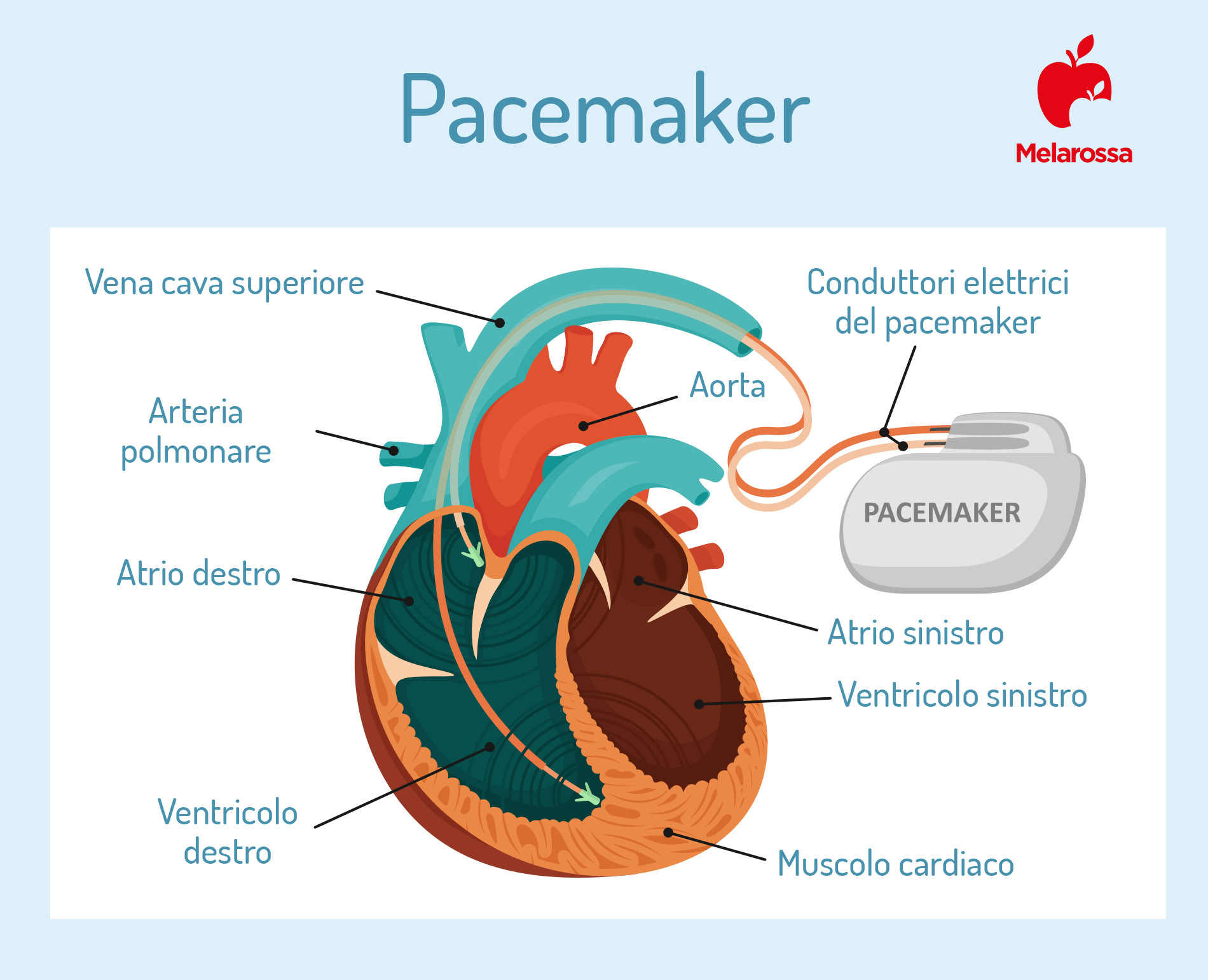 Pacemaker: che cos'è, come funziona, tipi, come si impianta, benefici, controindicazioni 4 pacemaker: come si impianta