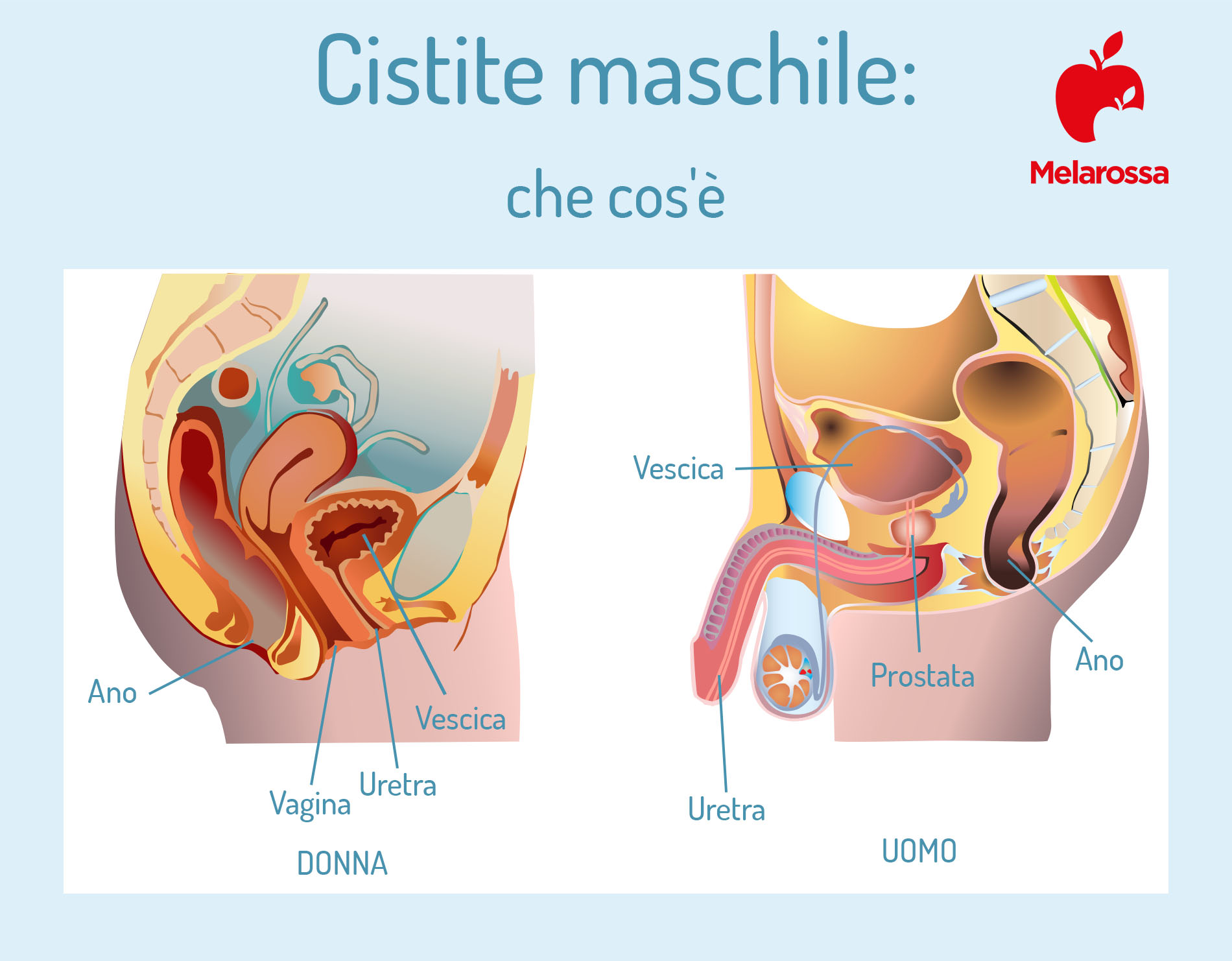 Cistite maschile: che cos'è, cause e sintomi, diagnosi e cure 1 cistite maschile: che cos'è