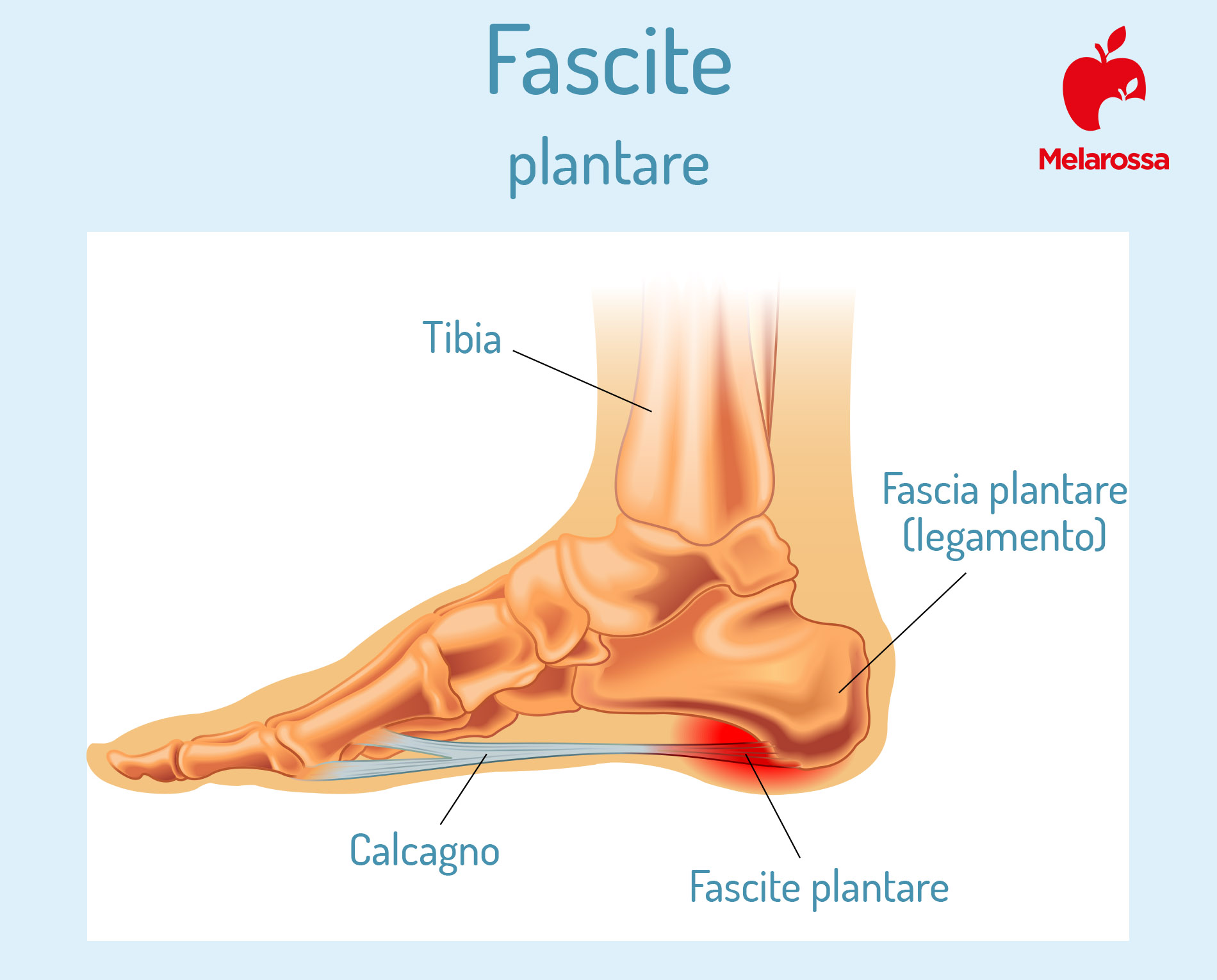 Fascite plantare: che cos'è, sintomi, cause, diagnosi, cure, esercizi di stretching per la pianta del piede 1 fascite plantare: che cos'è