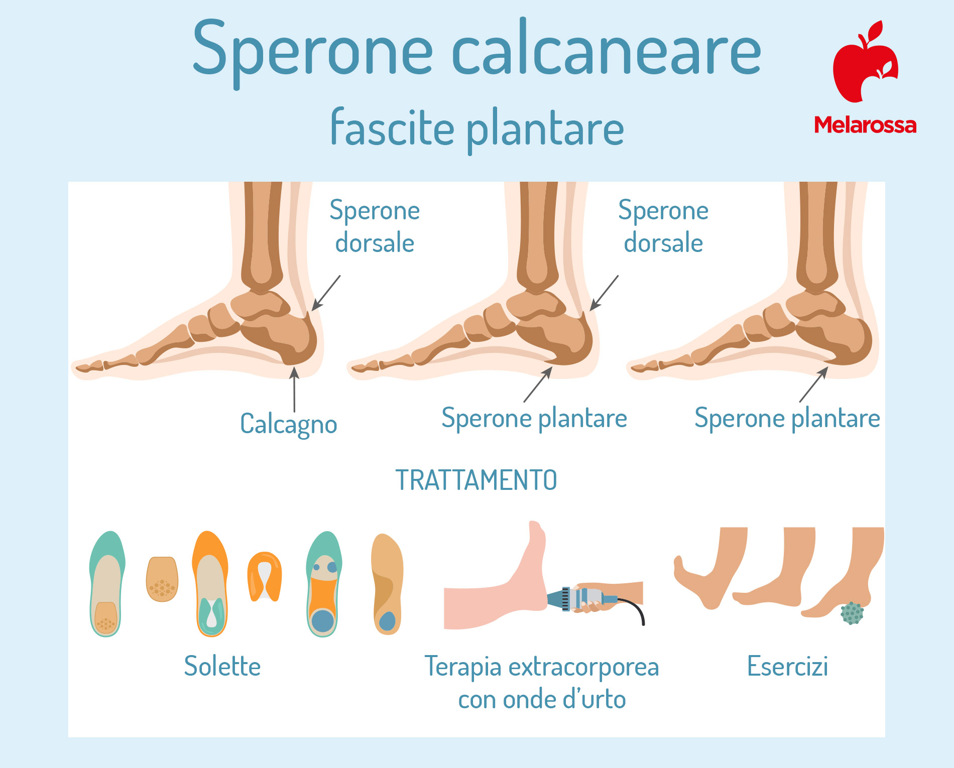 Fascite plantare: che cos'è, sintomi, cause, diagnosi, cure, esercizi di stretching per la pianta del piede 4 come curare la fascite plantare