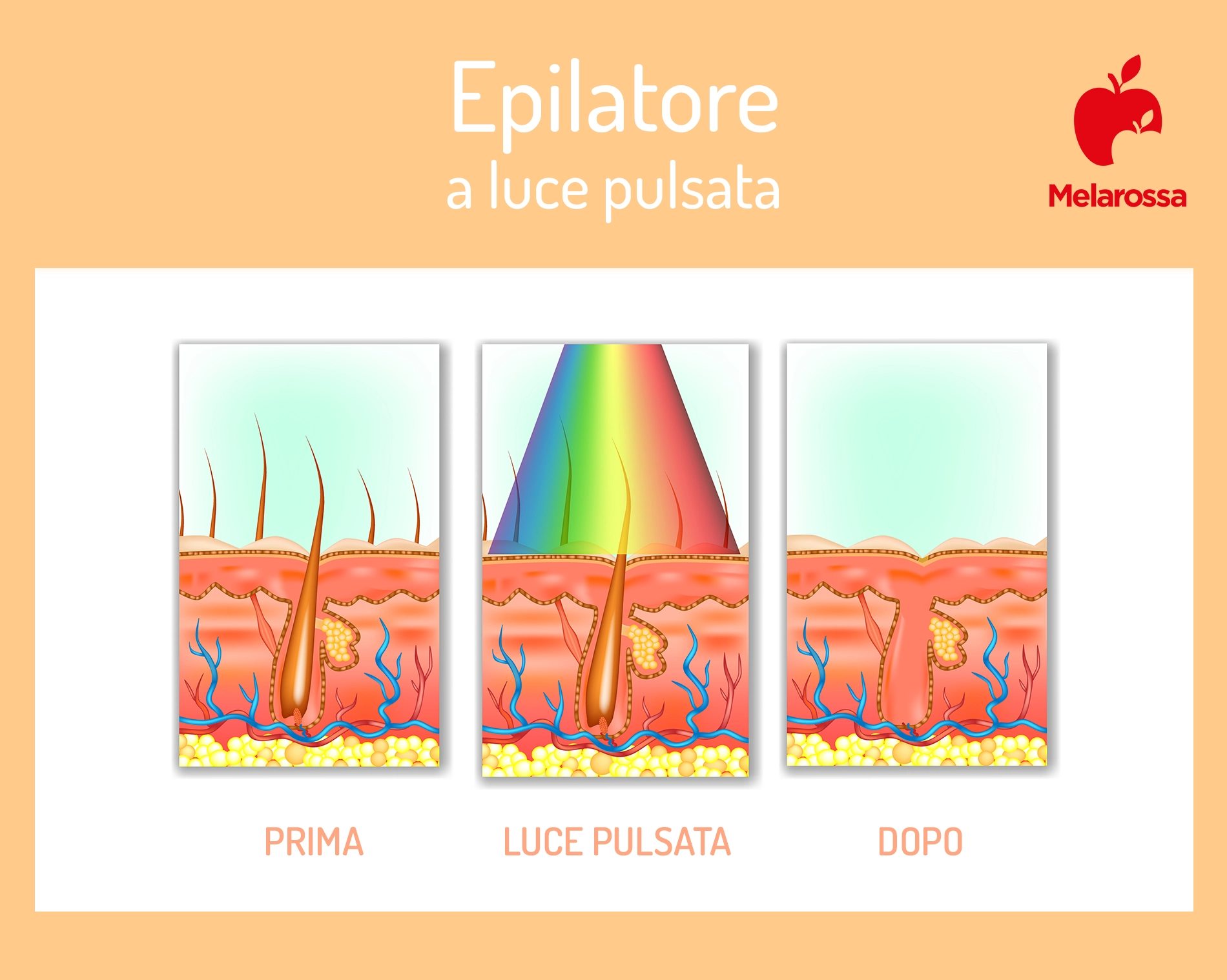 Epilatore a luce pulsata a casa: come funziona, vantaggi e quale comprare 1 grafica che spiega come funziona l'effetto dell'epilatore a luce pulsata sul pelo prima e dopo