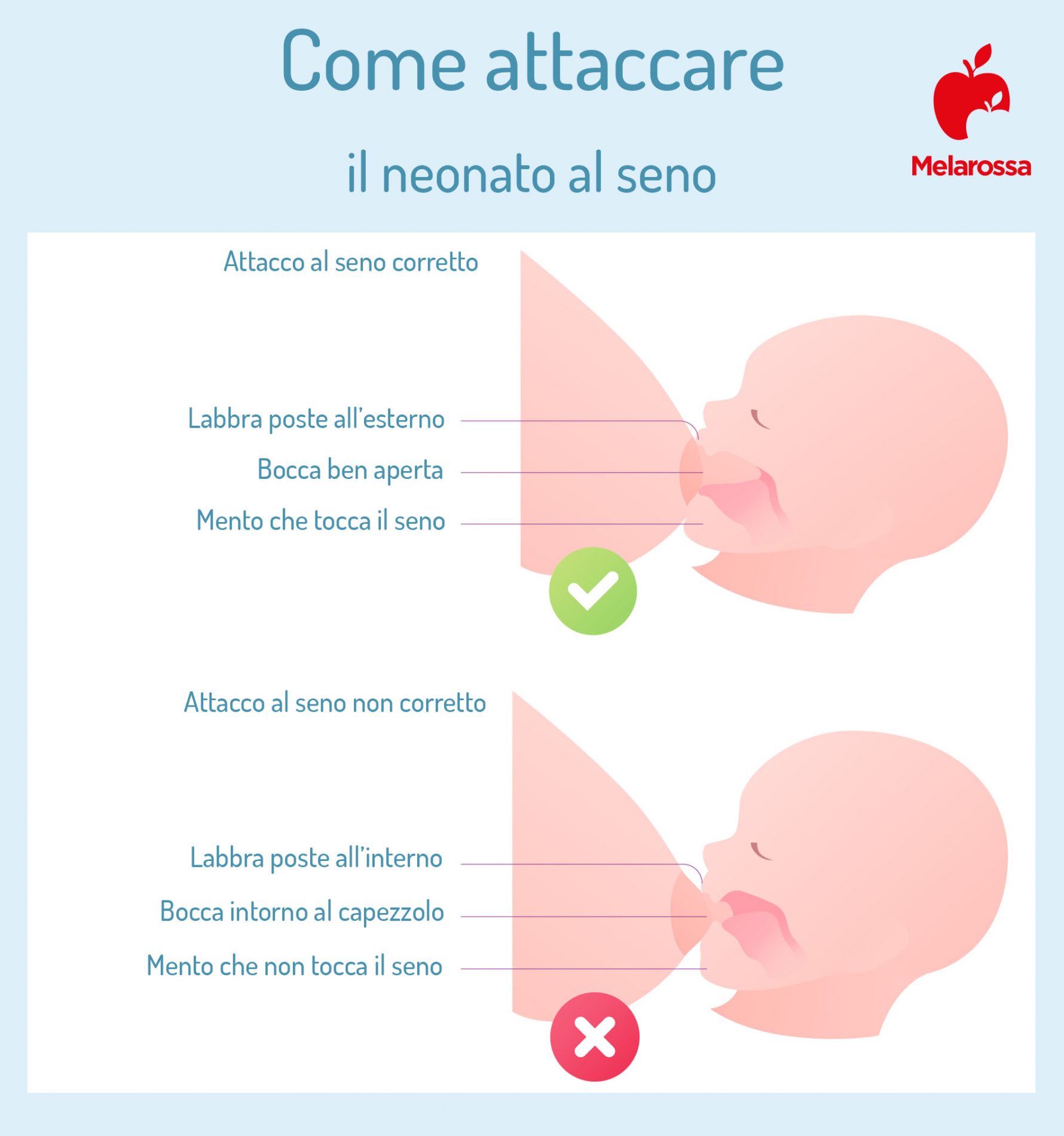 Mastite al seno: che cos'è, sintomi, cause e cosa fare? 3 mastite allattamento al seno come attaccare il neonato al seno 1