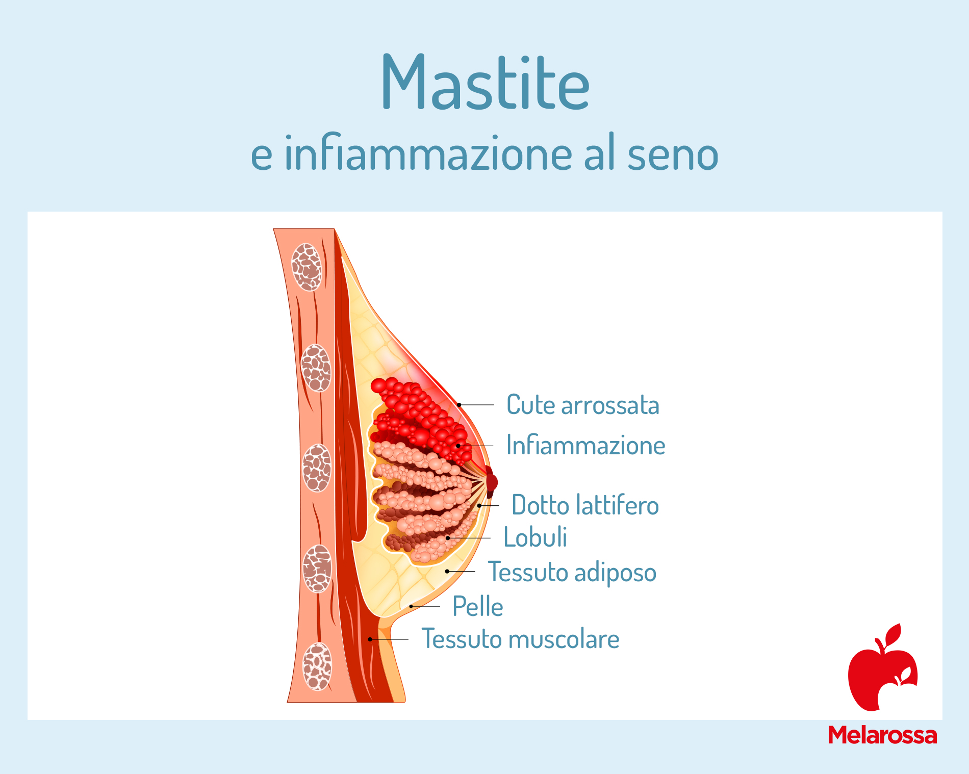 Mastite al seno: che cos'è, sintomi, cause e cosa fare? 1 mastite e infiammazione al seno