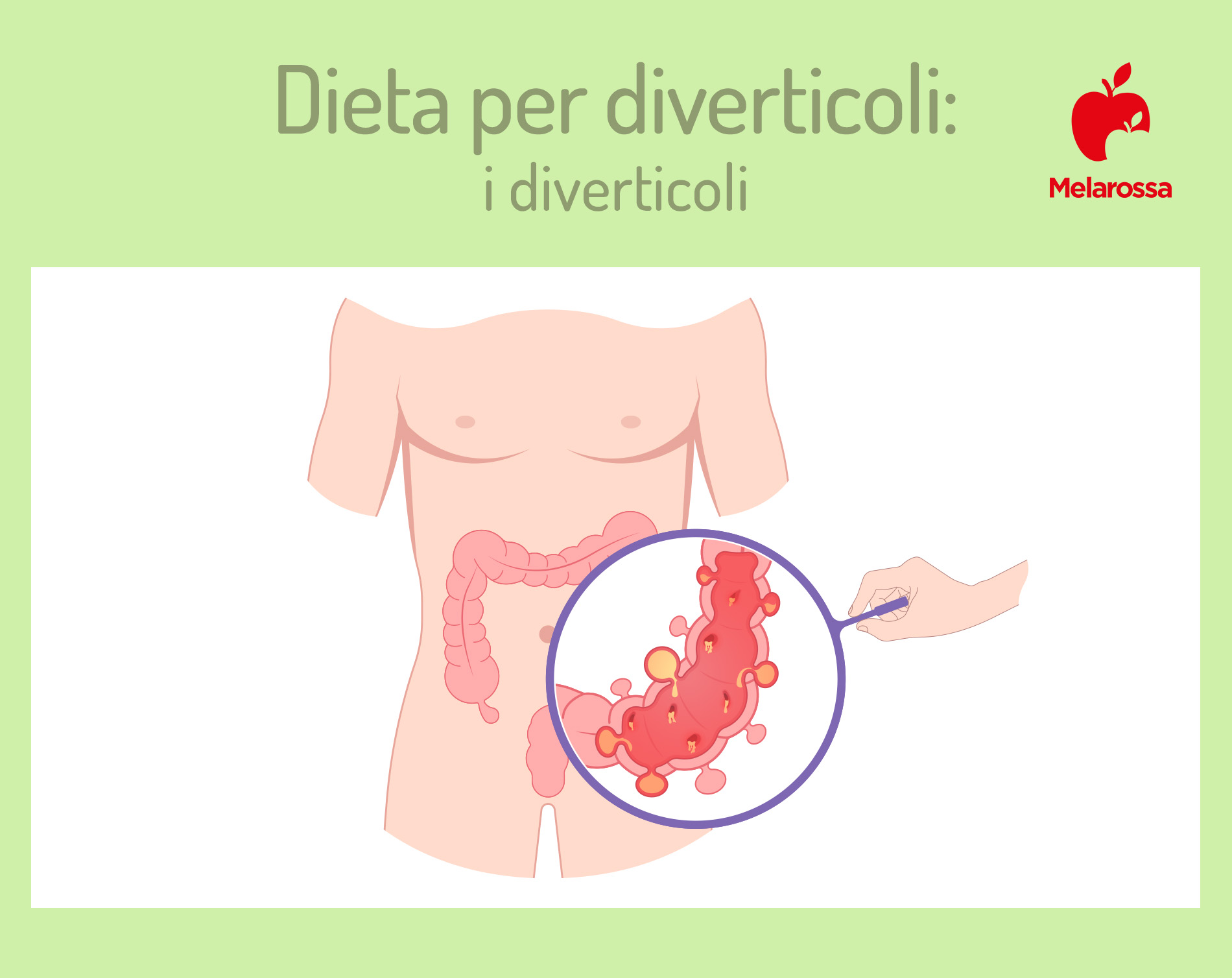 Dieta per diverticoli: cosa mangiare, cibi vietati, esempio di menù 1 Dieta per diverticoli: cosa sono i diverticoli