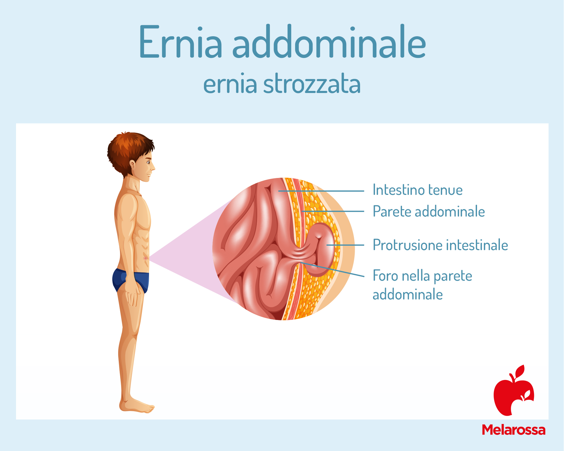 Ernia addominale: che cos'è, sintomi e cause, come si cura 2 ernia addominale: ernia strozzata