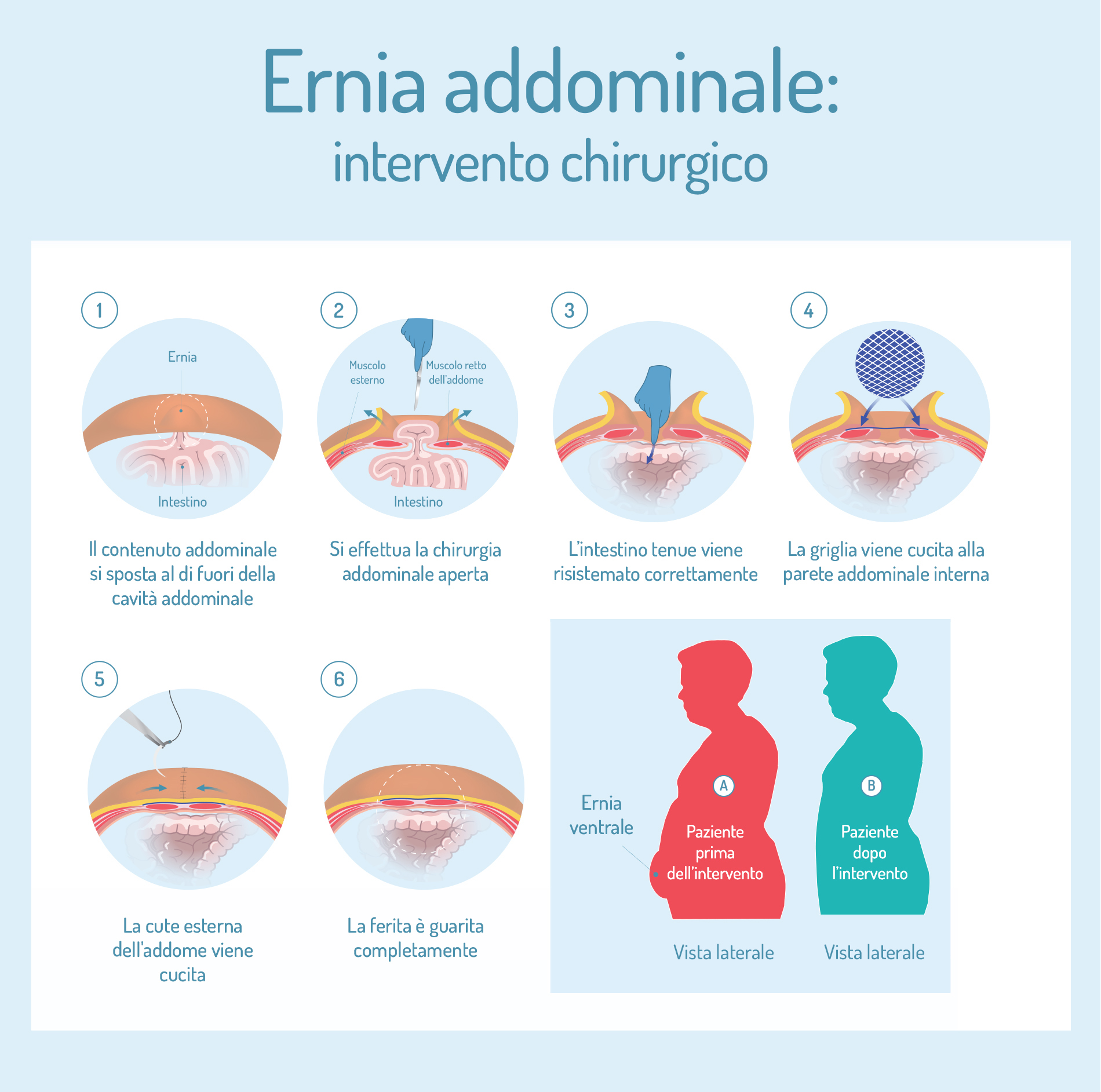 Ernia addominale: che cos'è, sintomi e cause, come si cura 4 ernia addominale: intervento chirurgico