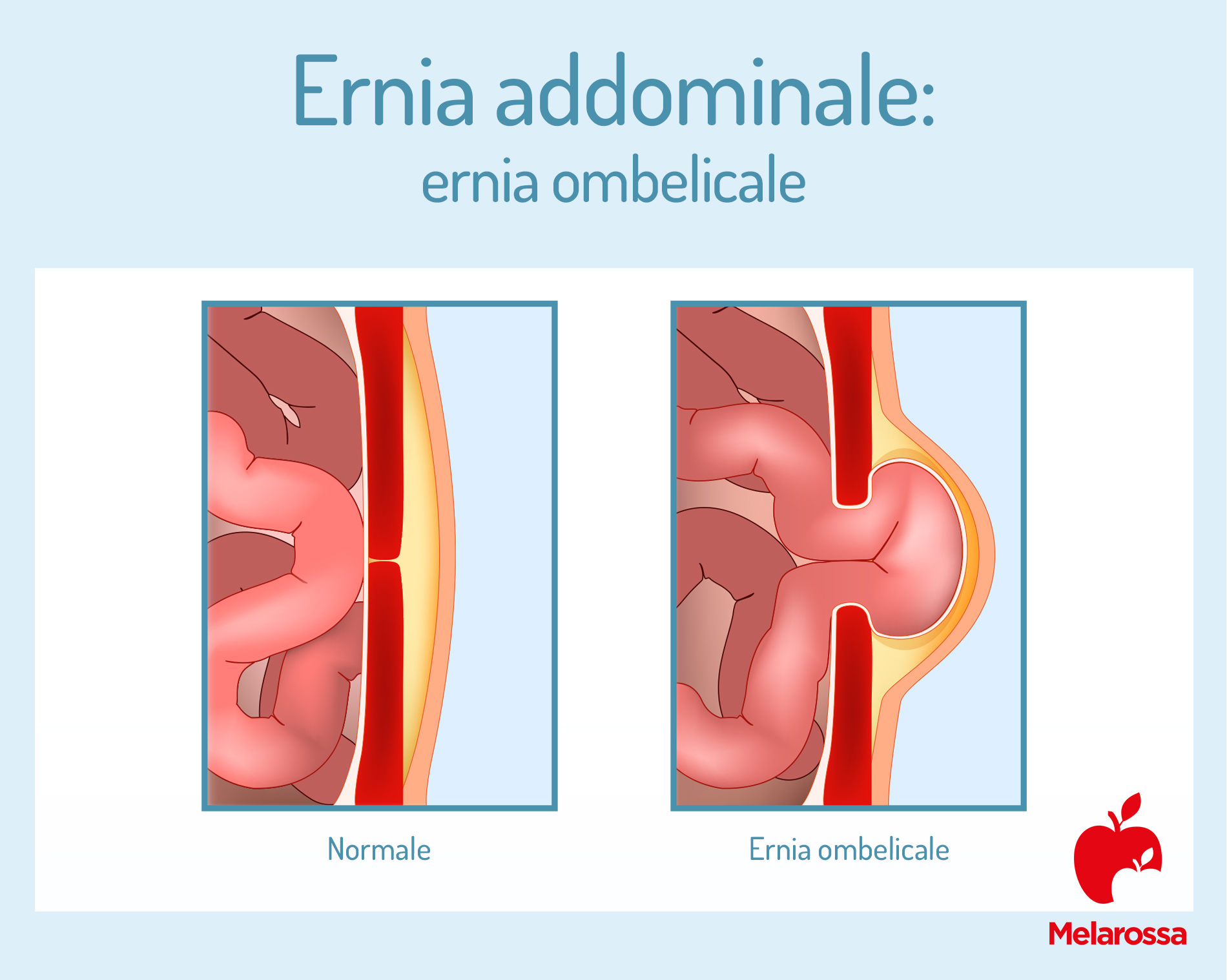 Ernia addominale: che cos'è, sintomi e cause, come si cura 1 ernia addominale: che cos'è