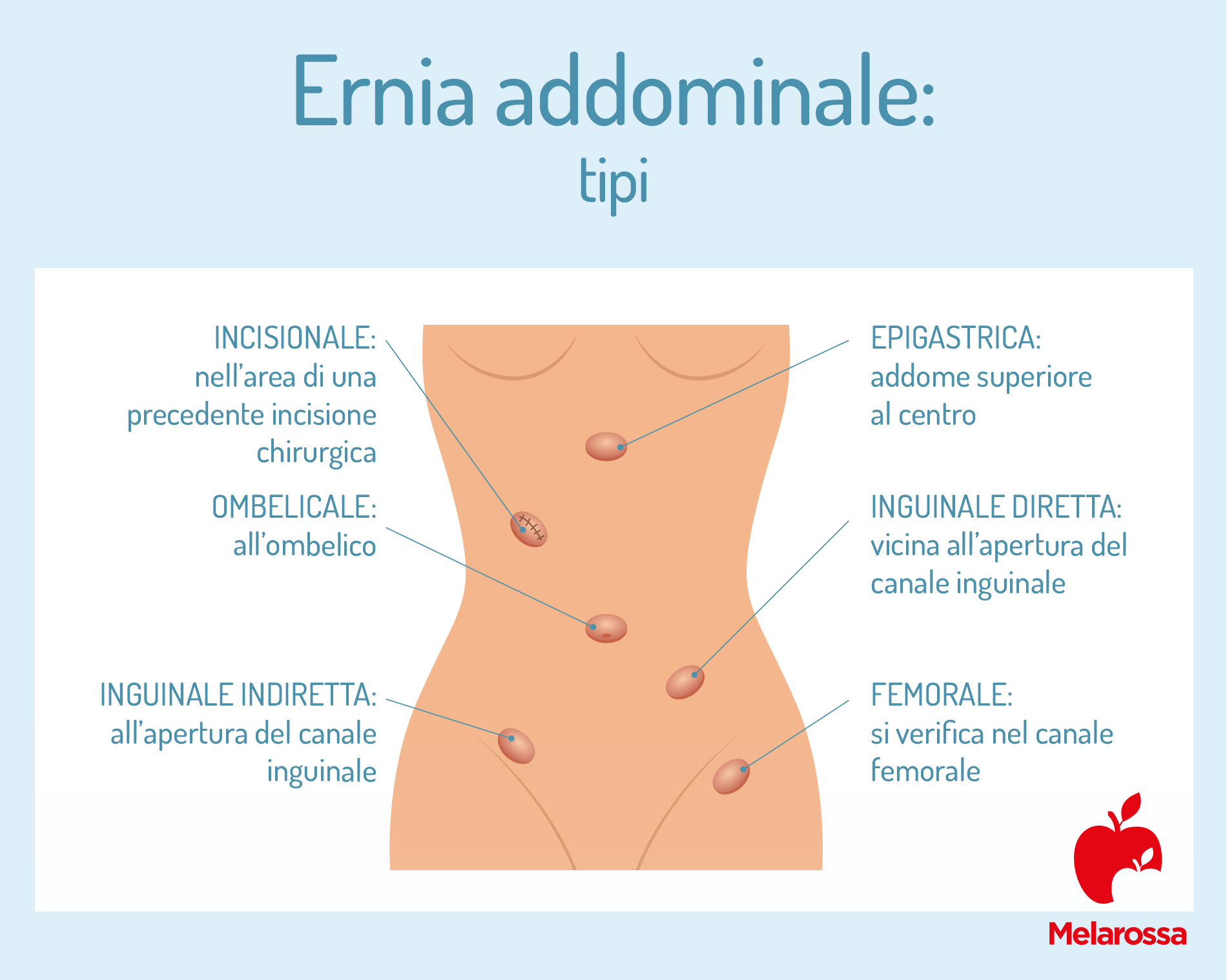 Ernia addominale: che cos'è, sintomi e cause, come si cura 3 ernia addominale: tipi
