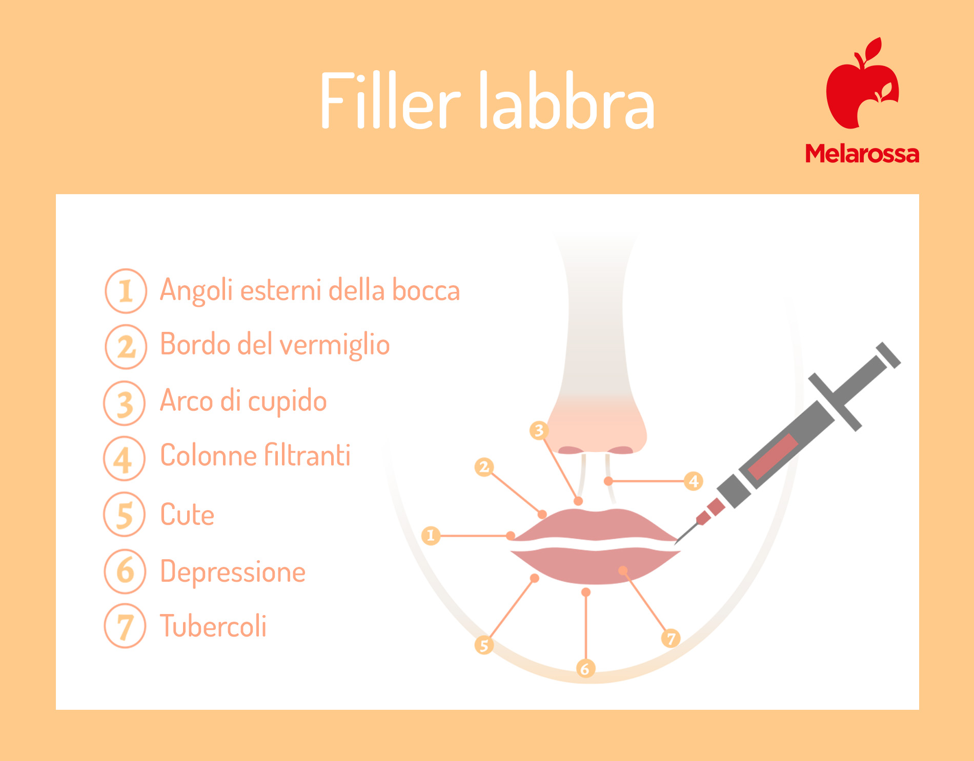Filler labbra: che cos'è, come funziona il trattamento, quanto costa, risultati 2 filler trattamento: come funziona il trattamento