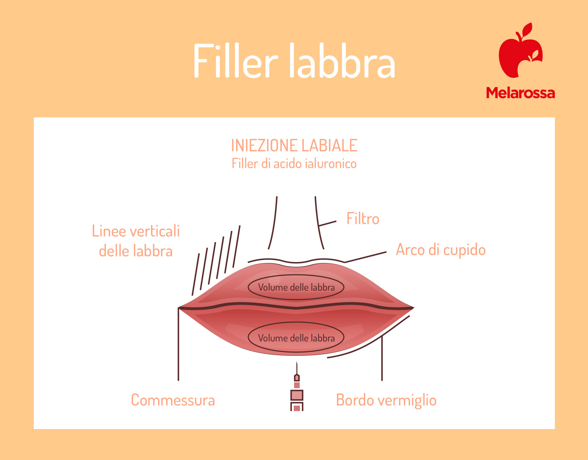 Filler labbra: che cos'è, come funziona il trattamento, quanto costa, risultati 1 filler labbra: dove iniettare il filler