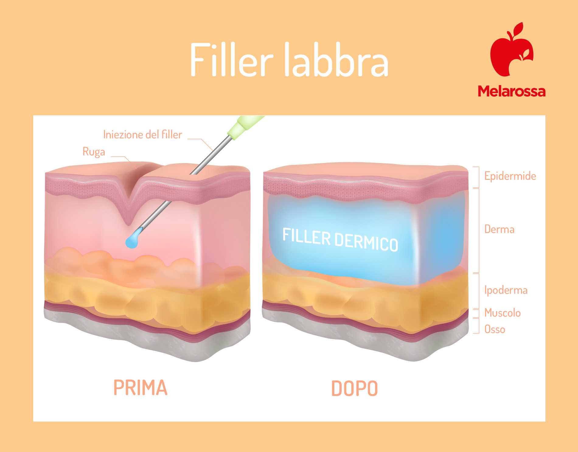 Filler labbra: che cos'è, come funziona il trattamento, quanto costa, risultati 4 filler labbra procedura