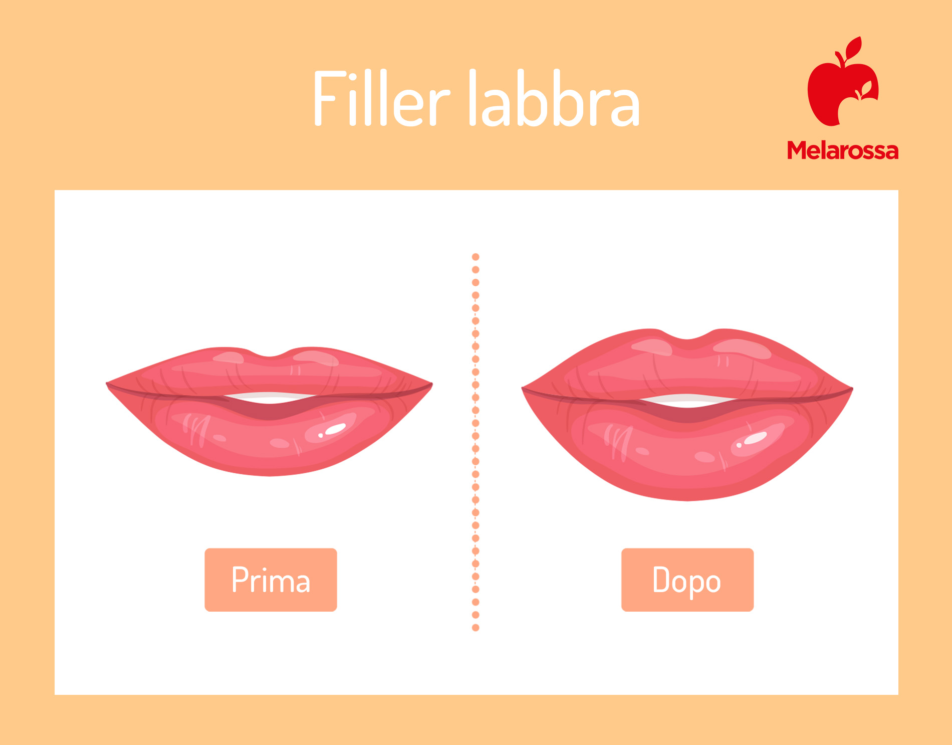 Filler labbra: che cos'è, come funziona il trattamento, quanto costa, risultati 3 filler labbra: prima e dopo