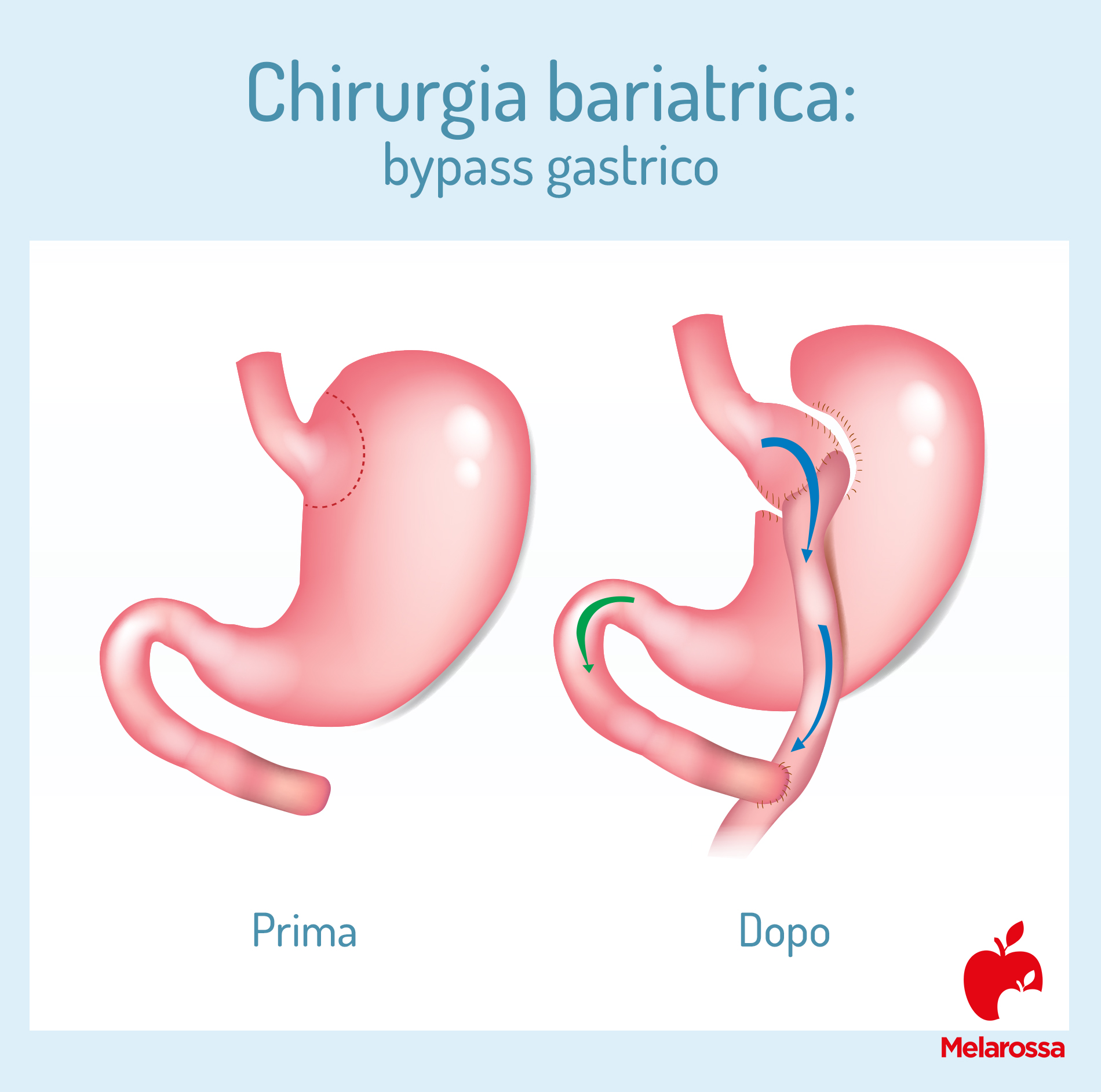 Chirurgia bariatrica: che cos'è, a cosa serve, tipologie di intervento, risultati, rischi e controindicazioni 5 chirurgia bariatrica: bypass gastrico