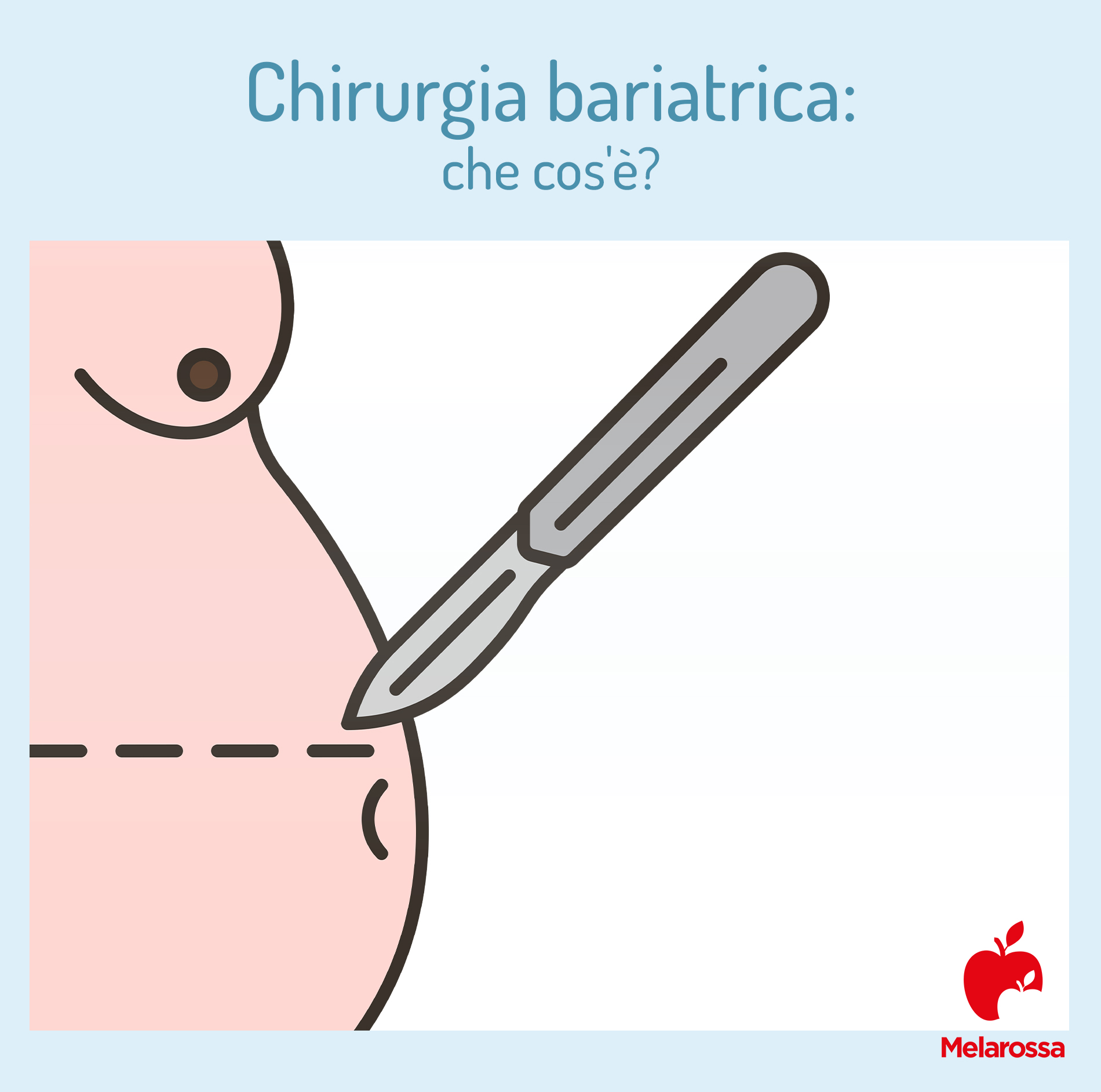 Chirurgia bariatrica: che cos'è, a cosa serve, tipologie di intervento, risultati, rischi e controindicazioni 1 chirurgia bariatrica: che cos'è?