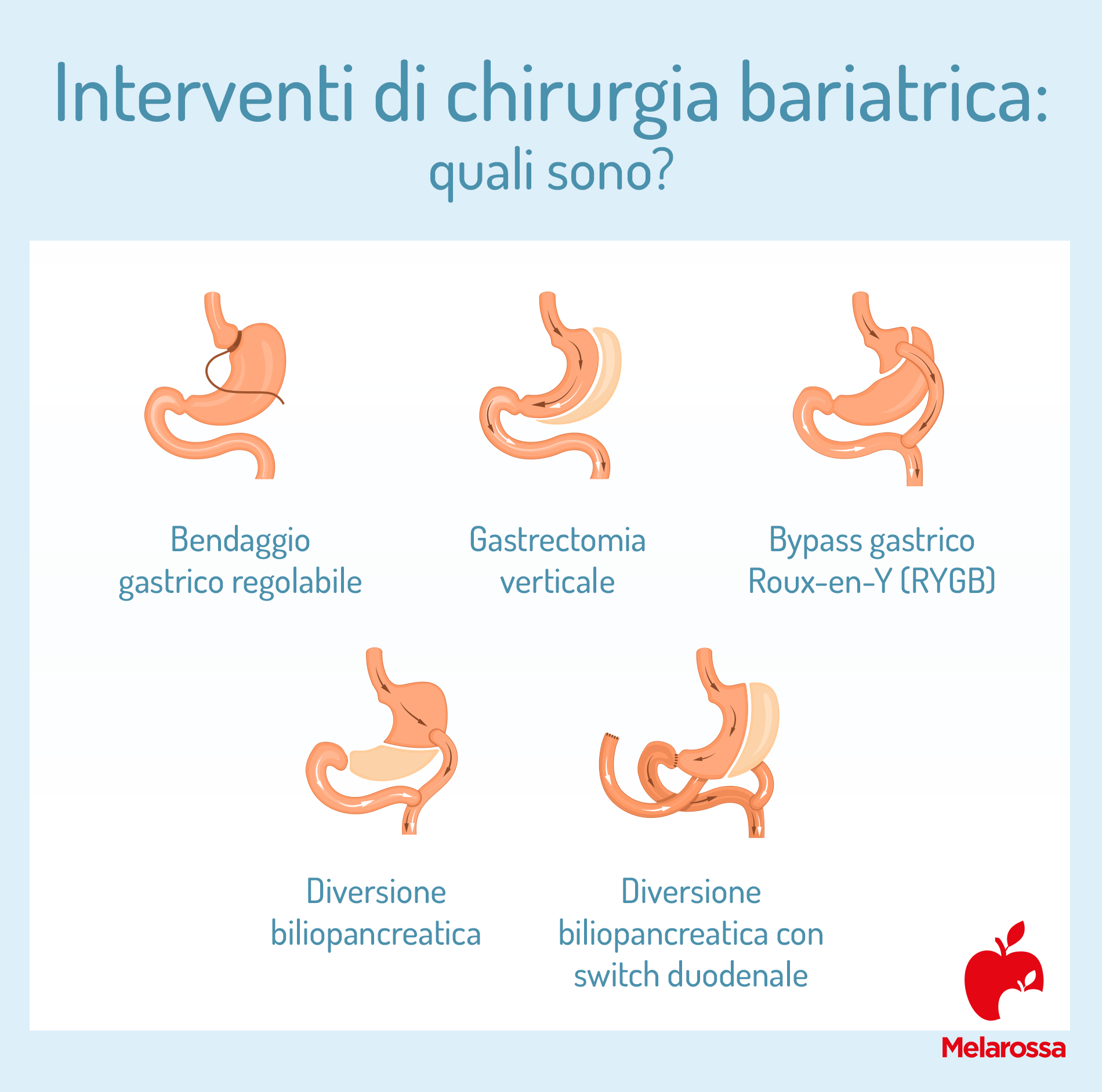 Chirurgia bariatrica: che cos'è, a cosa serve, tipologie di intervento, risultati, rischi e controindicazioni 4 chirurgia bariatrica: tipi di interventi