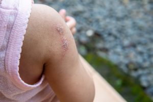 Cellulite infettiva: che cos&rsquo;&egrave;, cause, sintomi e cure