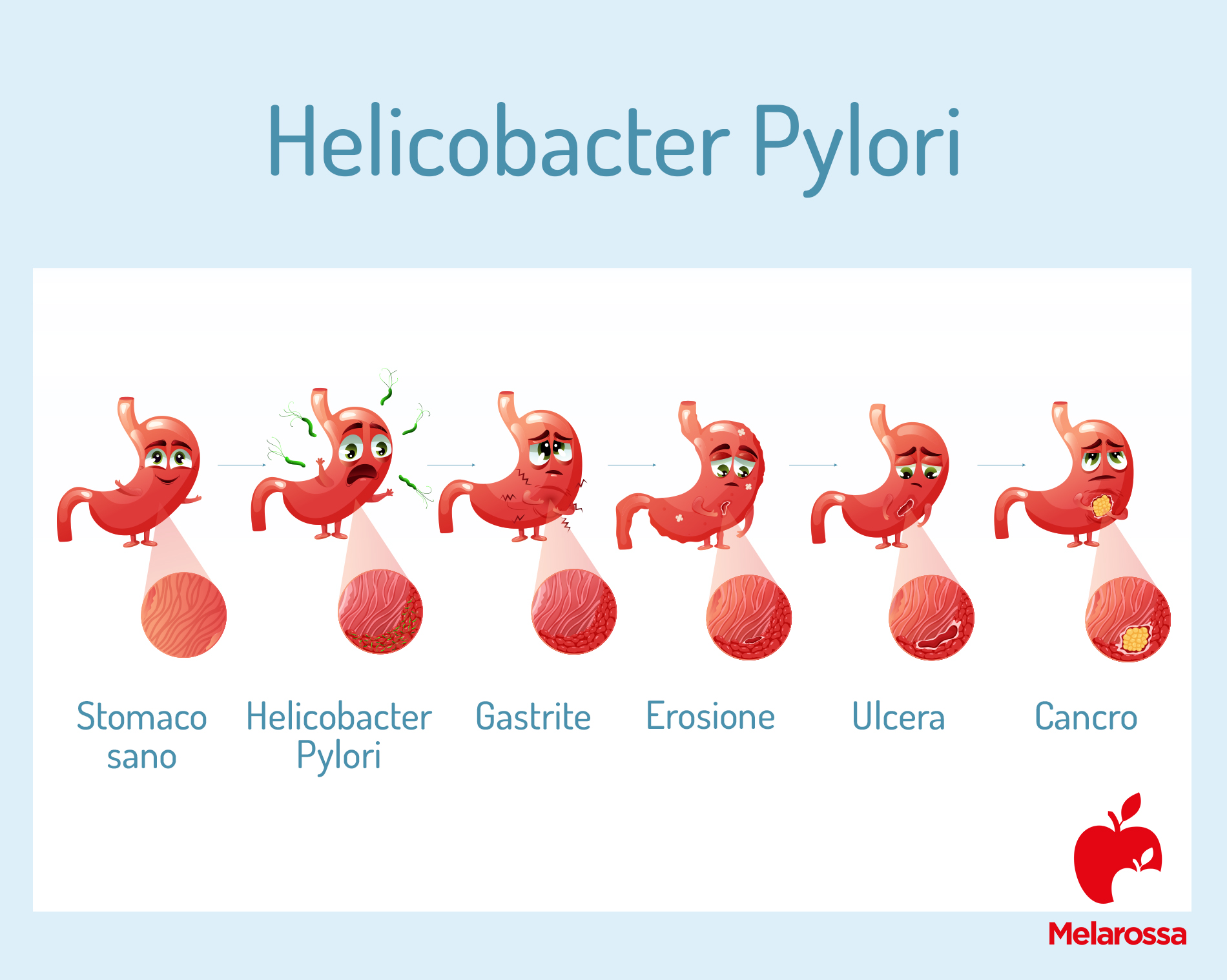 Helicobacter Pylori: cos'è, contagio, sintomi, complicanze, test e cure 2 helicobacter pylori: sintomi