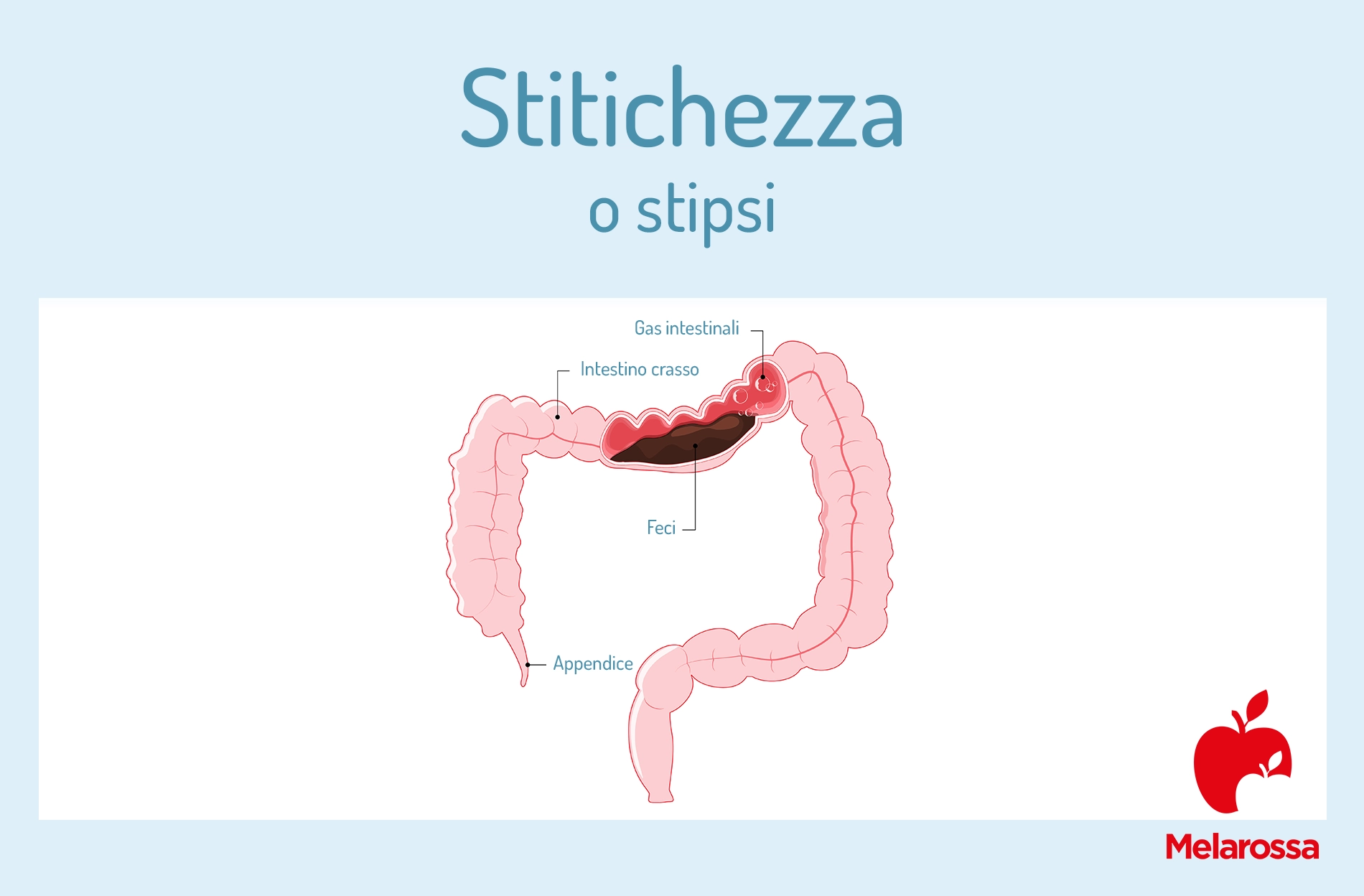 Stitichezza o stipsi: cause, sintomi, rimedi, cosa mangiare e cibi da evitare 2 grafica illustrativa sul colon per spiegare la stitichezza