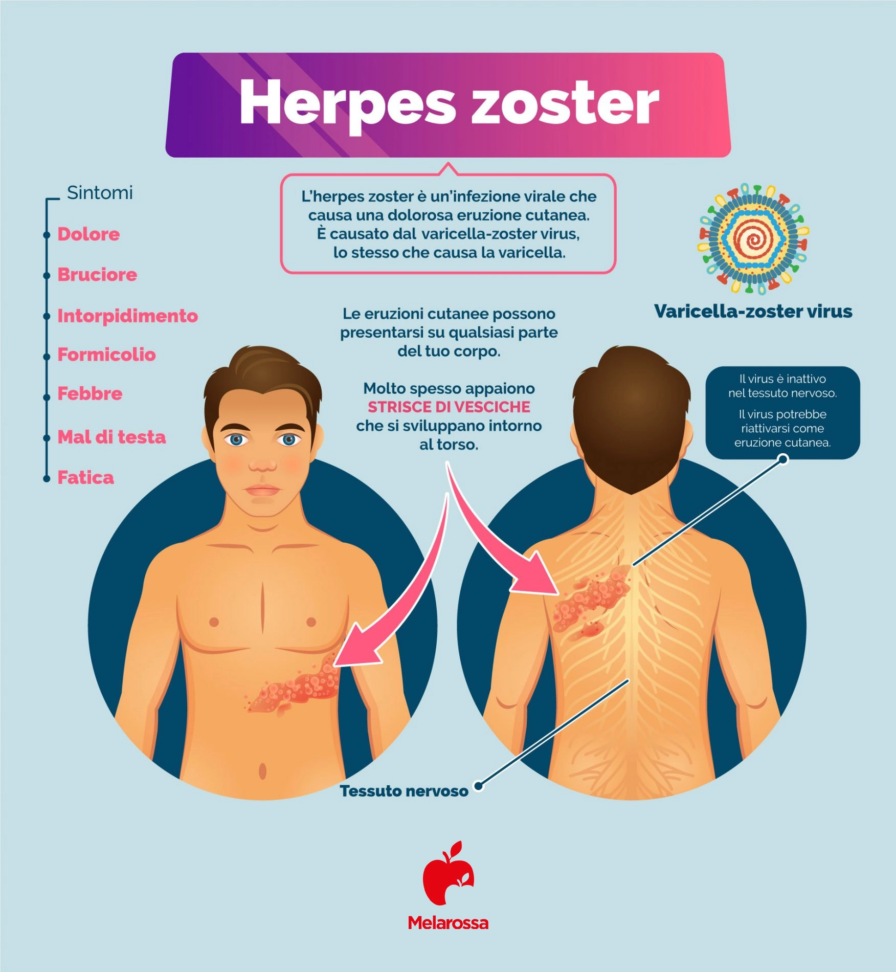 Herpes: cos'è, tipi, sintomi e trattamento 5 herpes zoster infografica copia