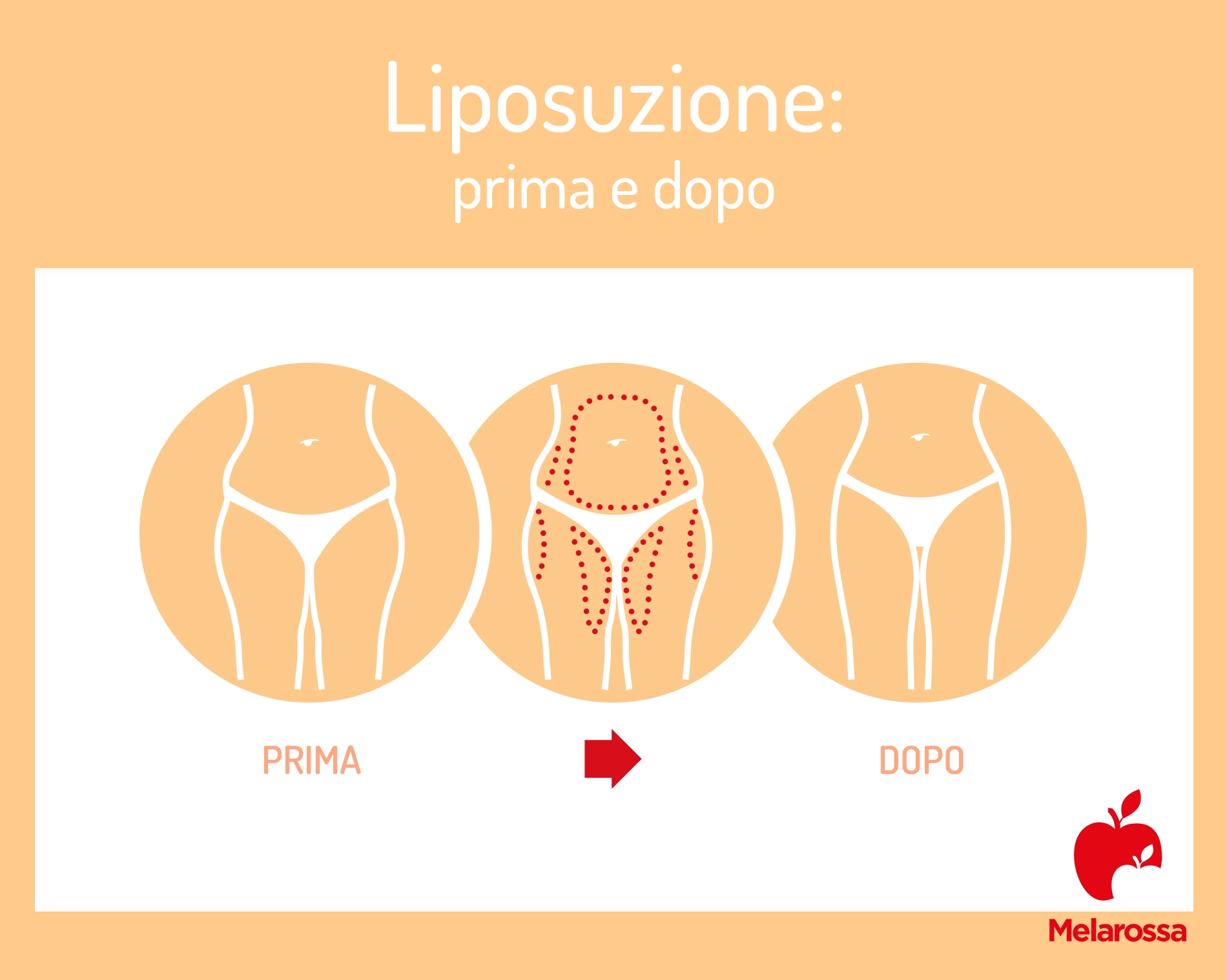 Liposuzione: cos'è, come funziona, benefici, costi e rischi 1 grafica che fa vedere corpo di una donna che risultato prima e dopo l'intervento