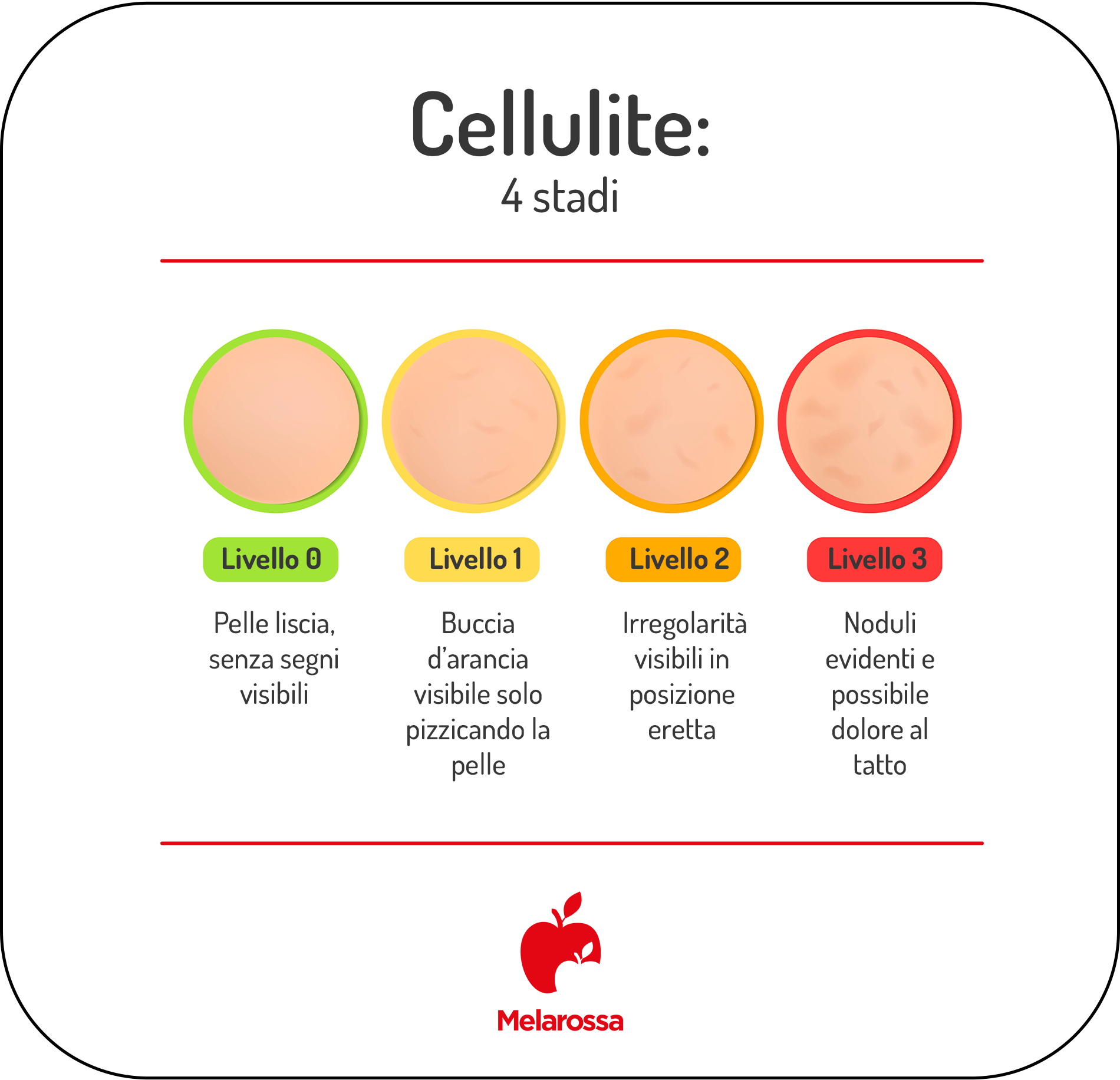 Cellulite: cos'è, cause e tipologie e come riconoscerla 1 infografica sulla cellulite con 4 stadi, dal livello 0 al livello 3, che mostra pelle liscia, buccia d’arancia, irregolarità visibili e noduli evidenti.