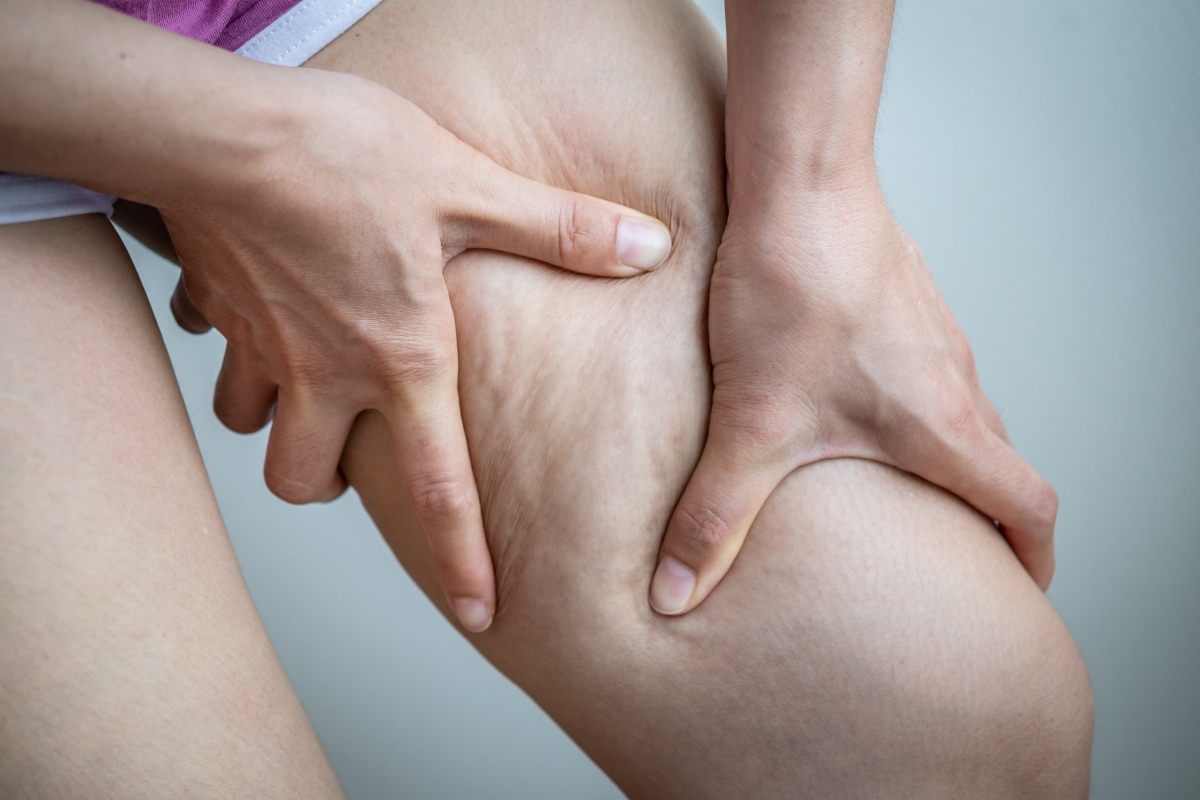 primo piano della coscia di una donna che si massaggia la coscia con 2 mani e si vede la cellulite